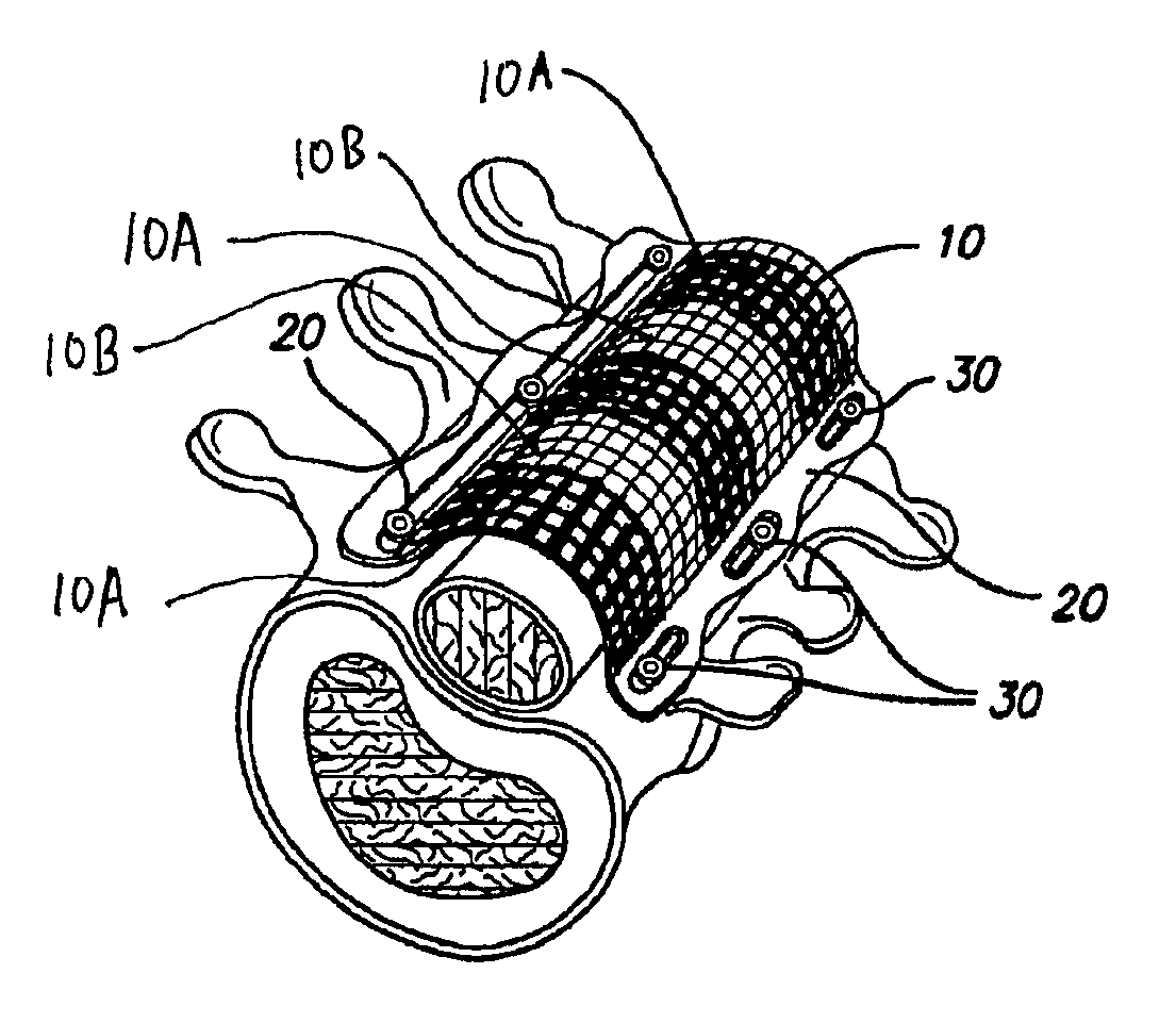 Bone anchored surgical mesh