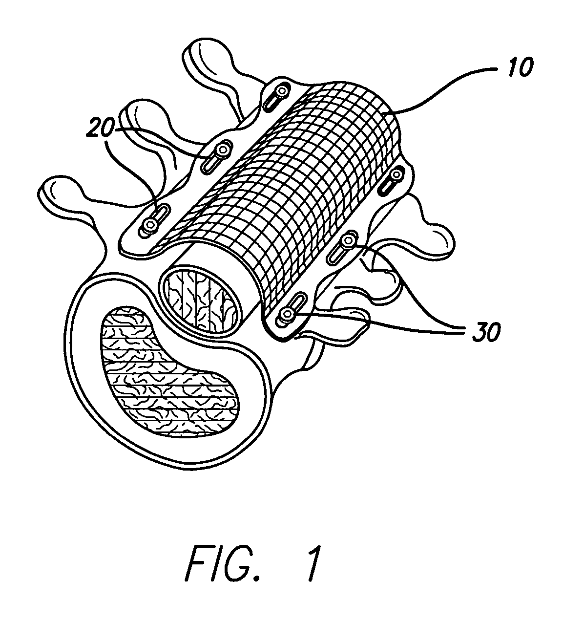 Bone anchored surgical mesh