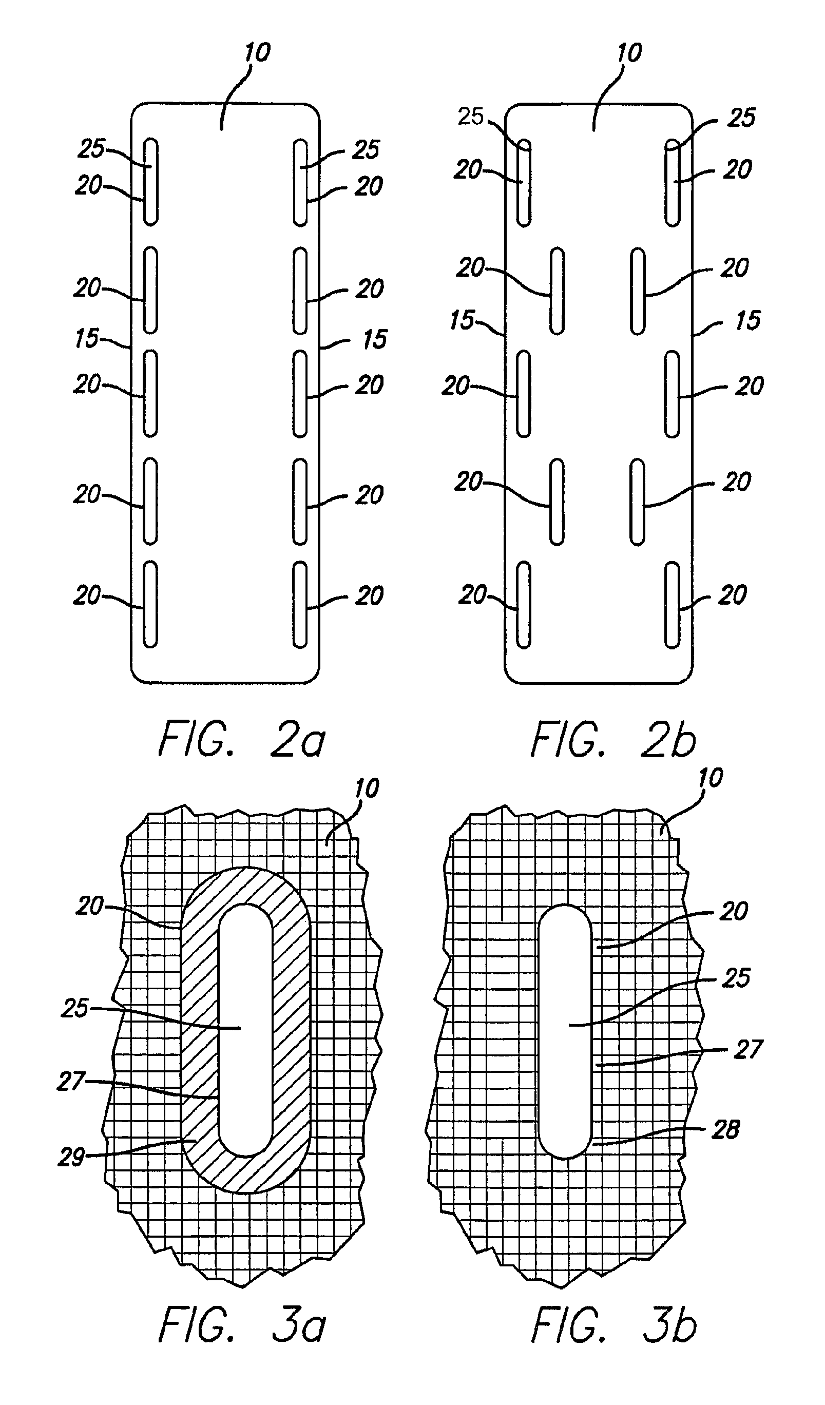 Bone anchored surgical mesh