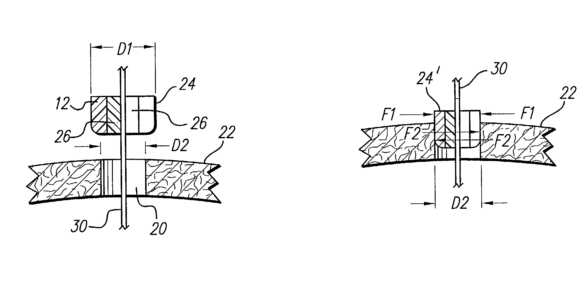 Cranial sealing plug