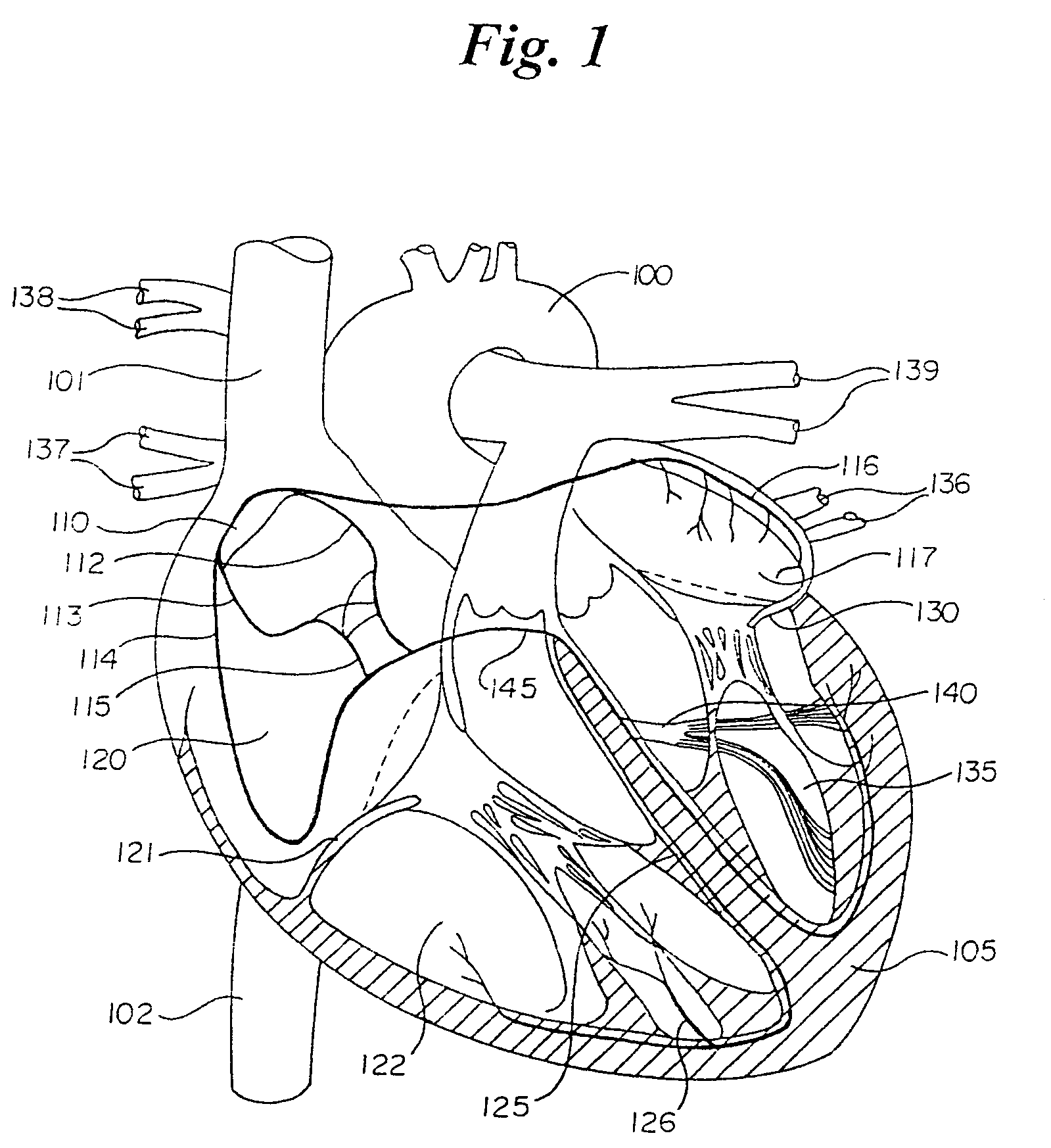 Percutaneous catheter and guidewire for filtering during ablation of myocardial or vascular tissue