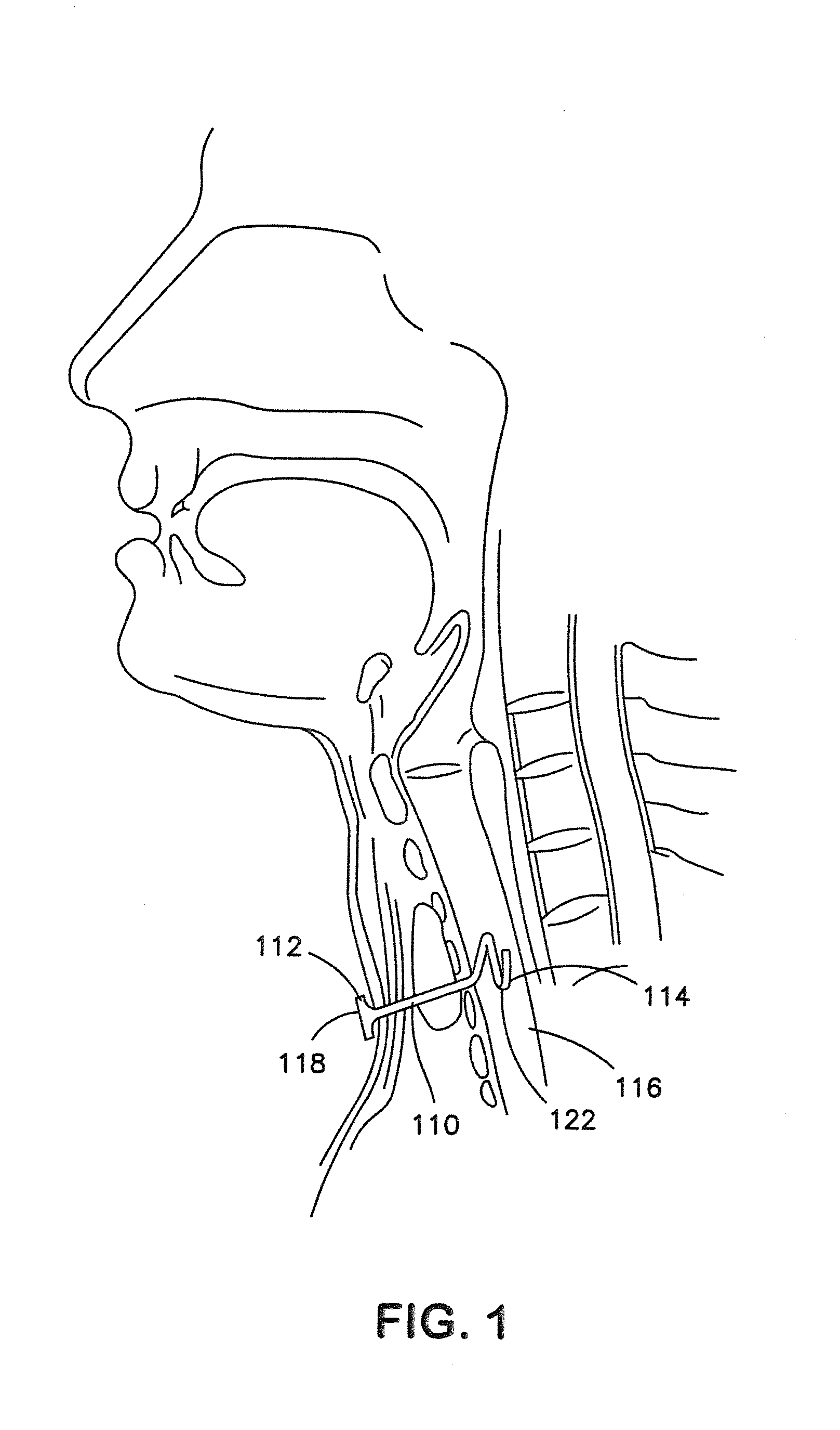 Tracheostomy Appliances and Methods for the Treatment of Sleep Apnea Syndromes