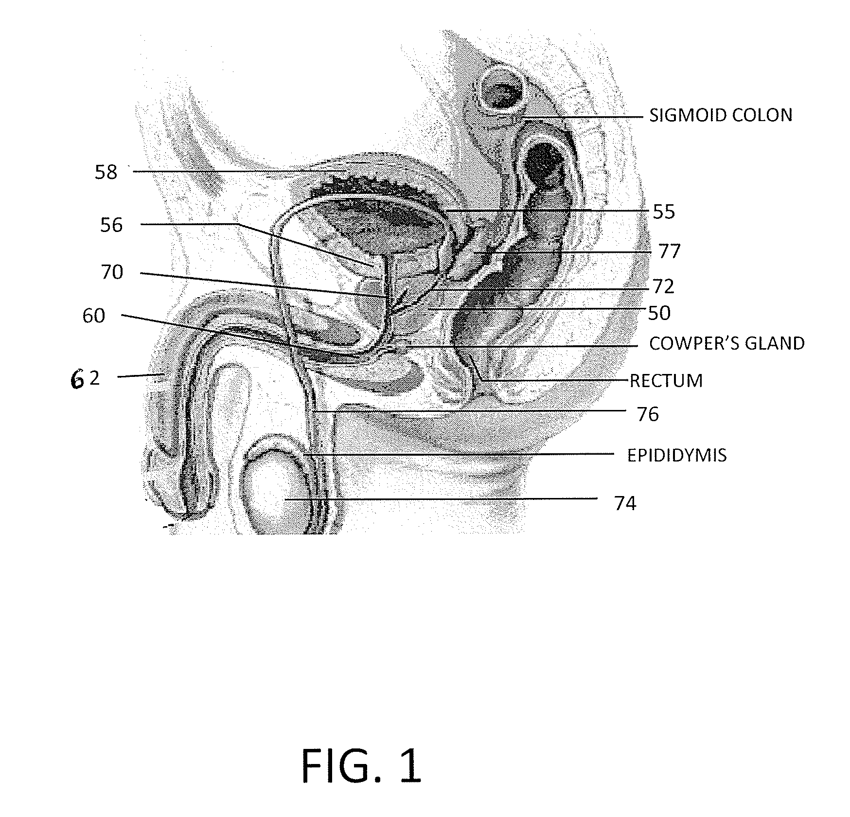 Systems and Methods for Prostate Treatment