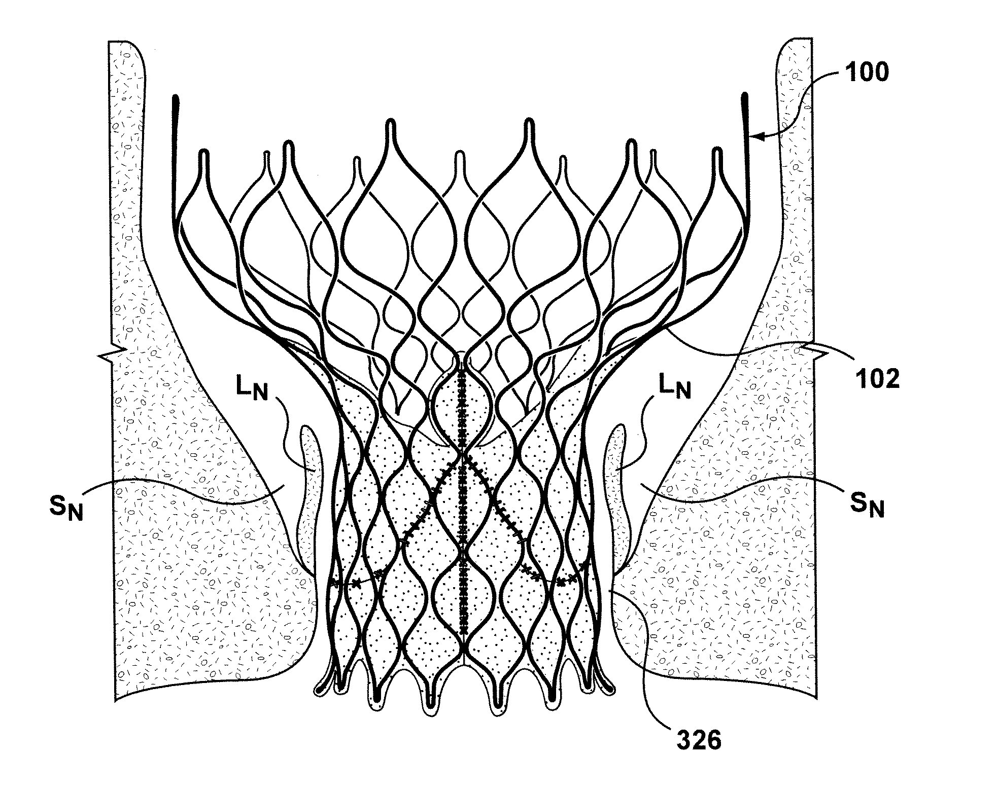 Transcatheter valve prosthesis having an external skirt for sealing and preventing paravalvular leakage