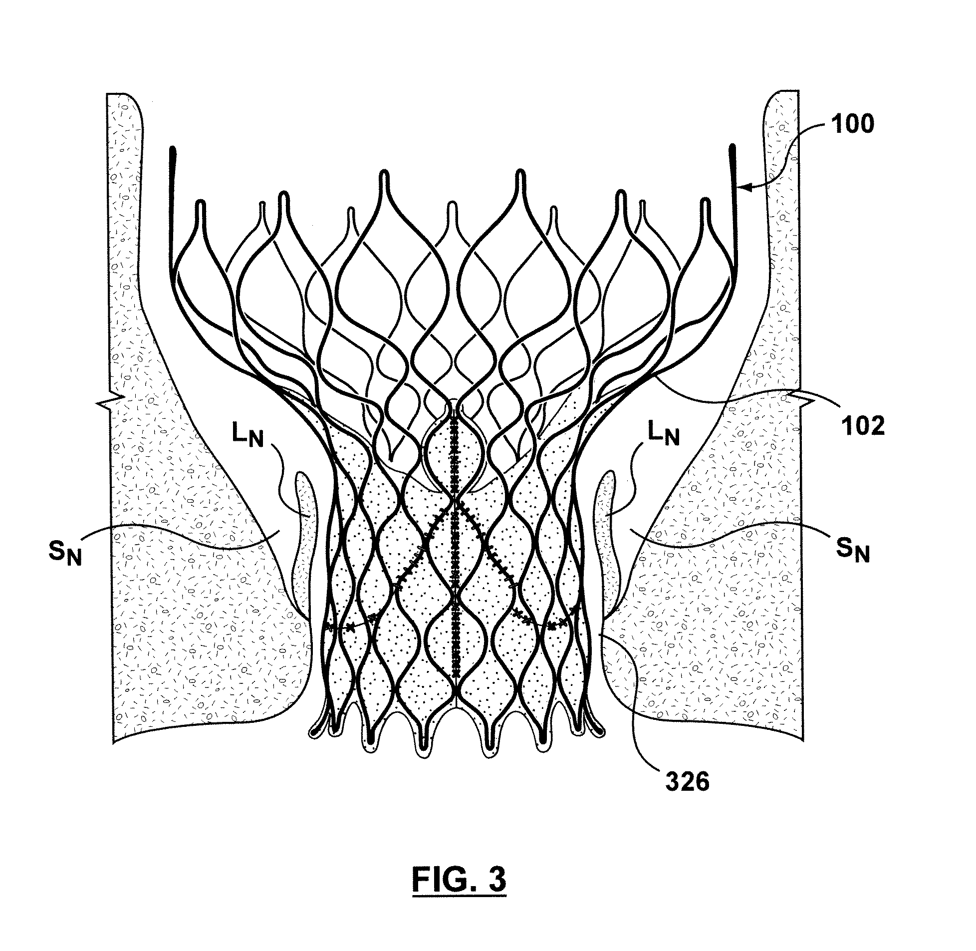 Transcatheter valve prosthesis having an external skirt for sealing and preventing paravalvular leakage