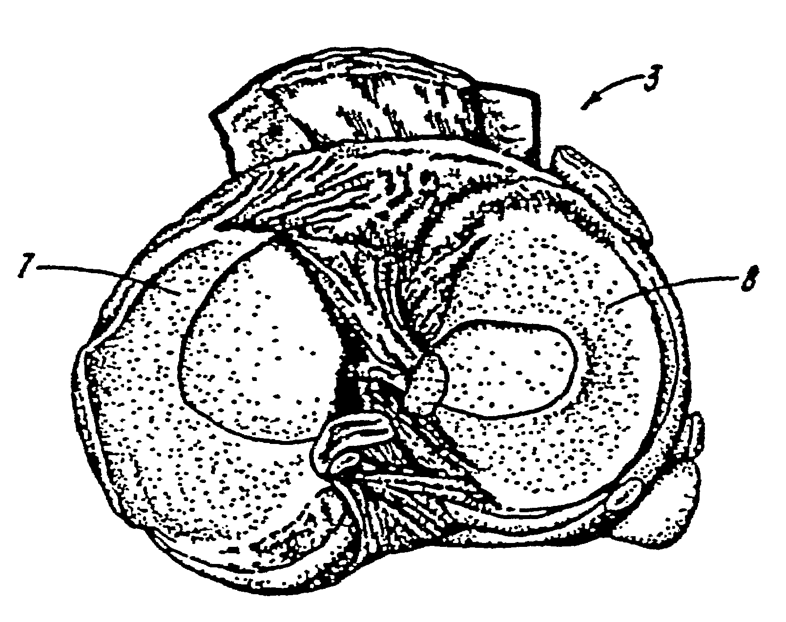 Galactosidase-treated prosthetic devices