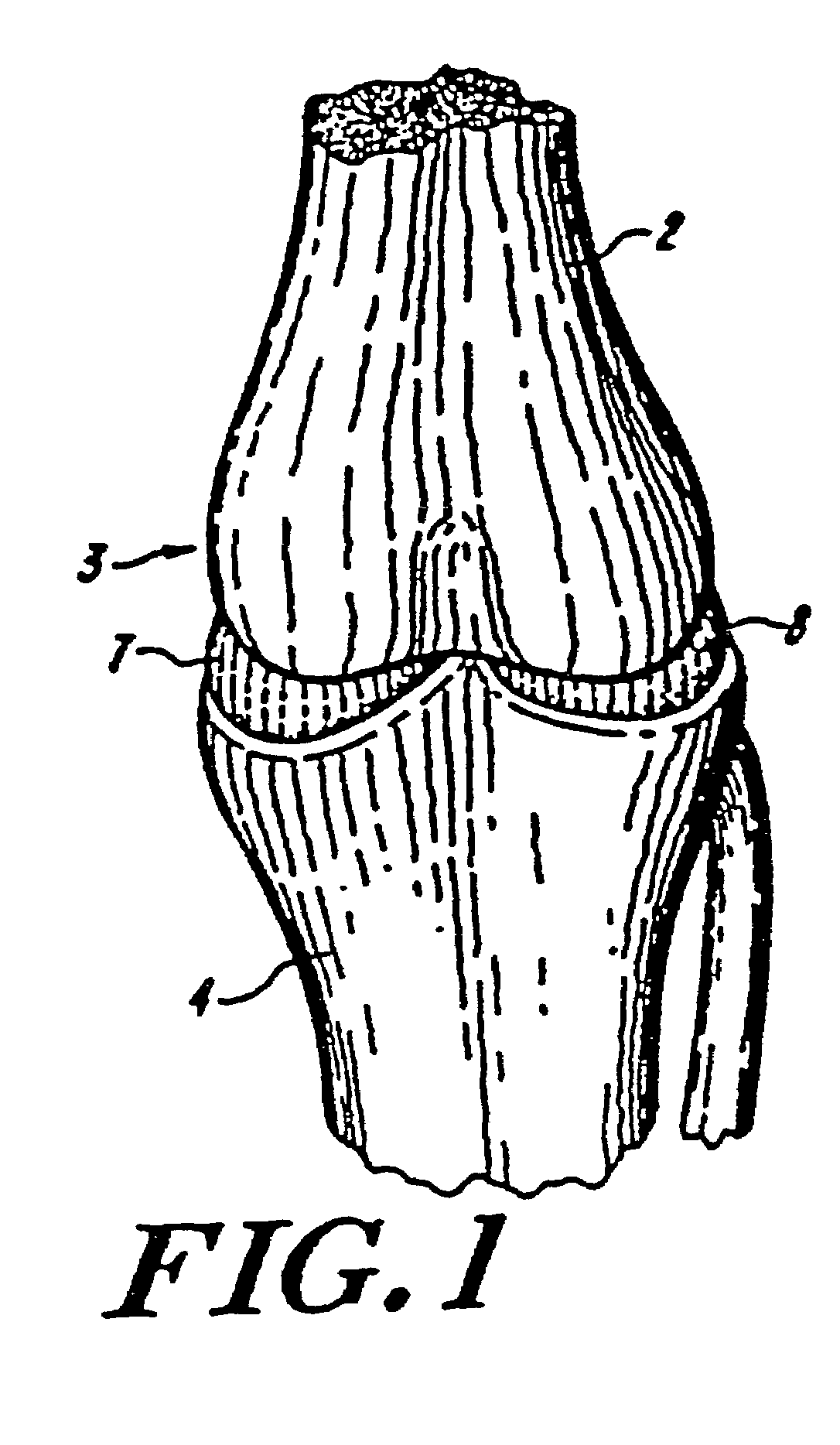 Galactosidase-treated prosthetic devices