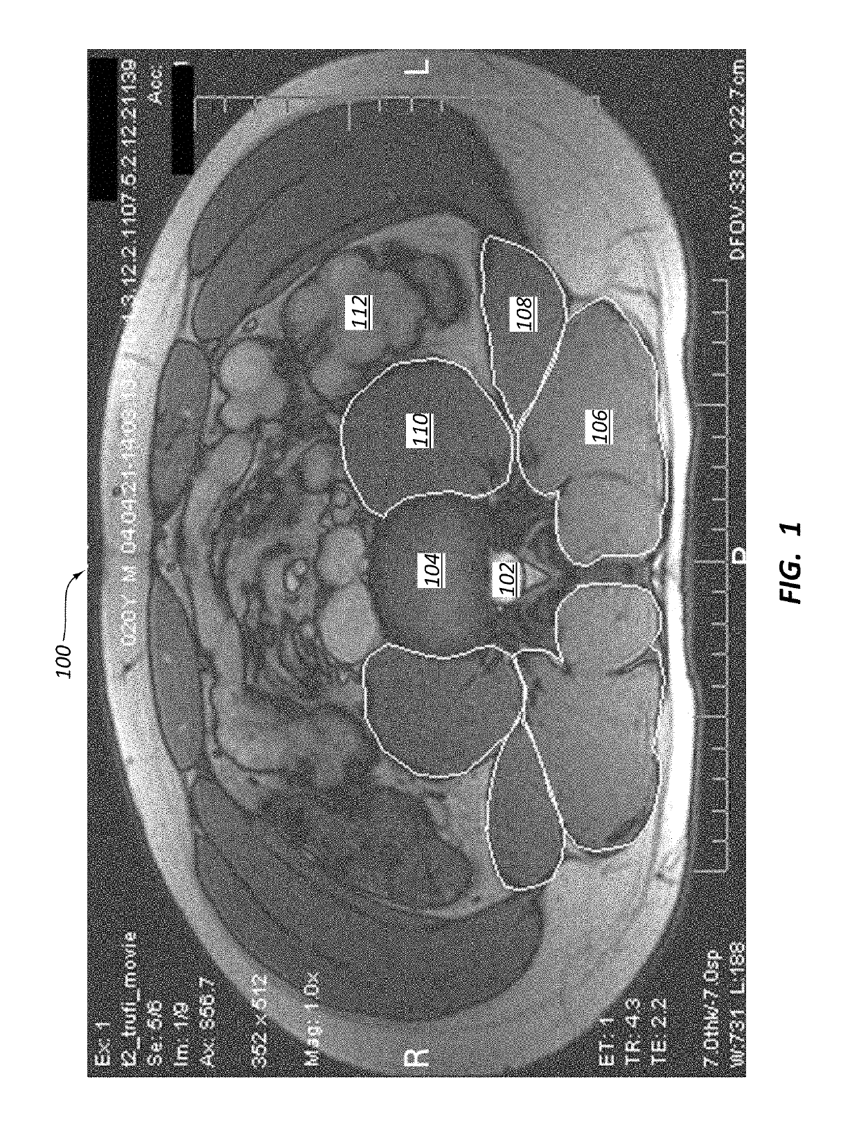 Posterior to lateral interbody fusion approach with associated instrumentation and implants