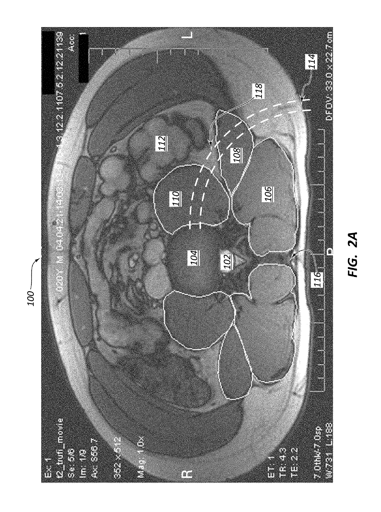 Posterior to lateral interbody fusion approach with associated instrumentation and implants