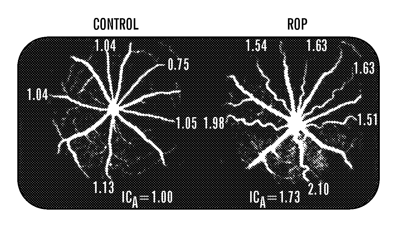 Protection of neural retina by reduction of rod metabolism