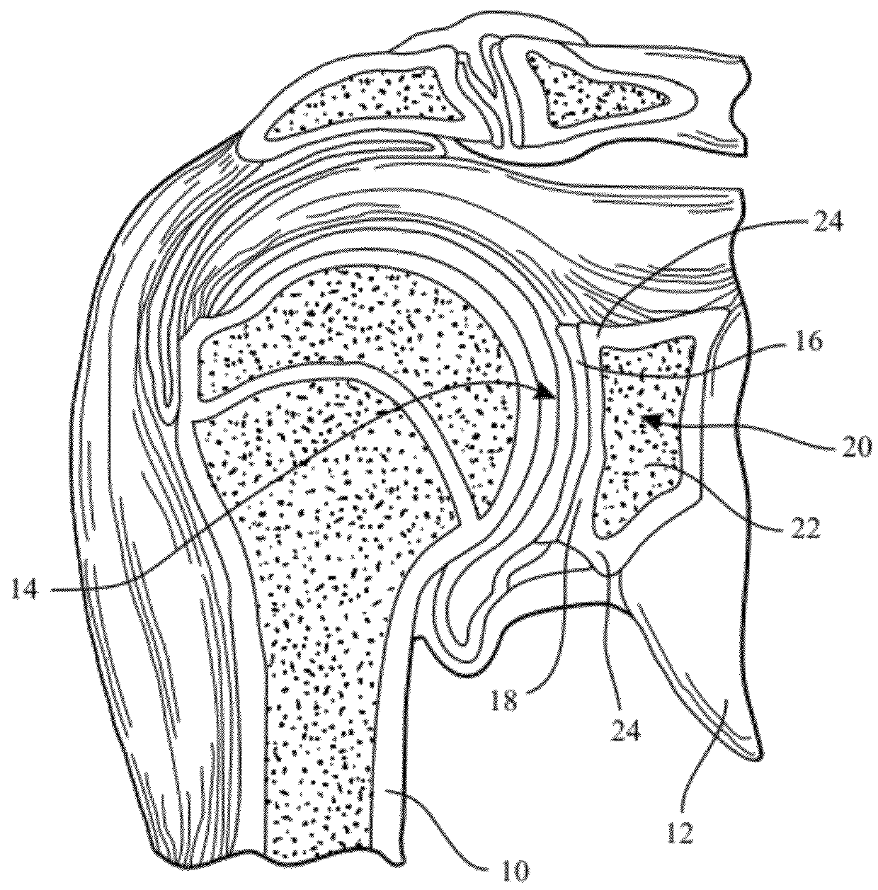 Device and method for retroversion correction for shoulder arthroplasty