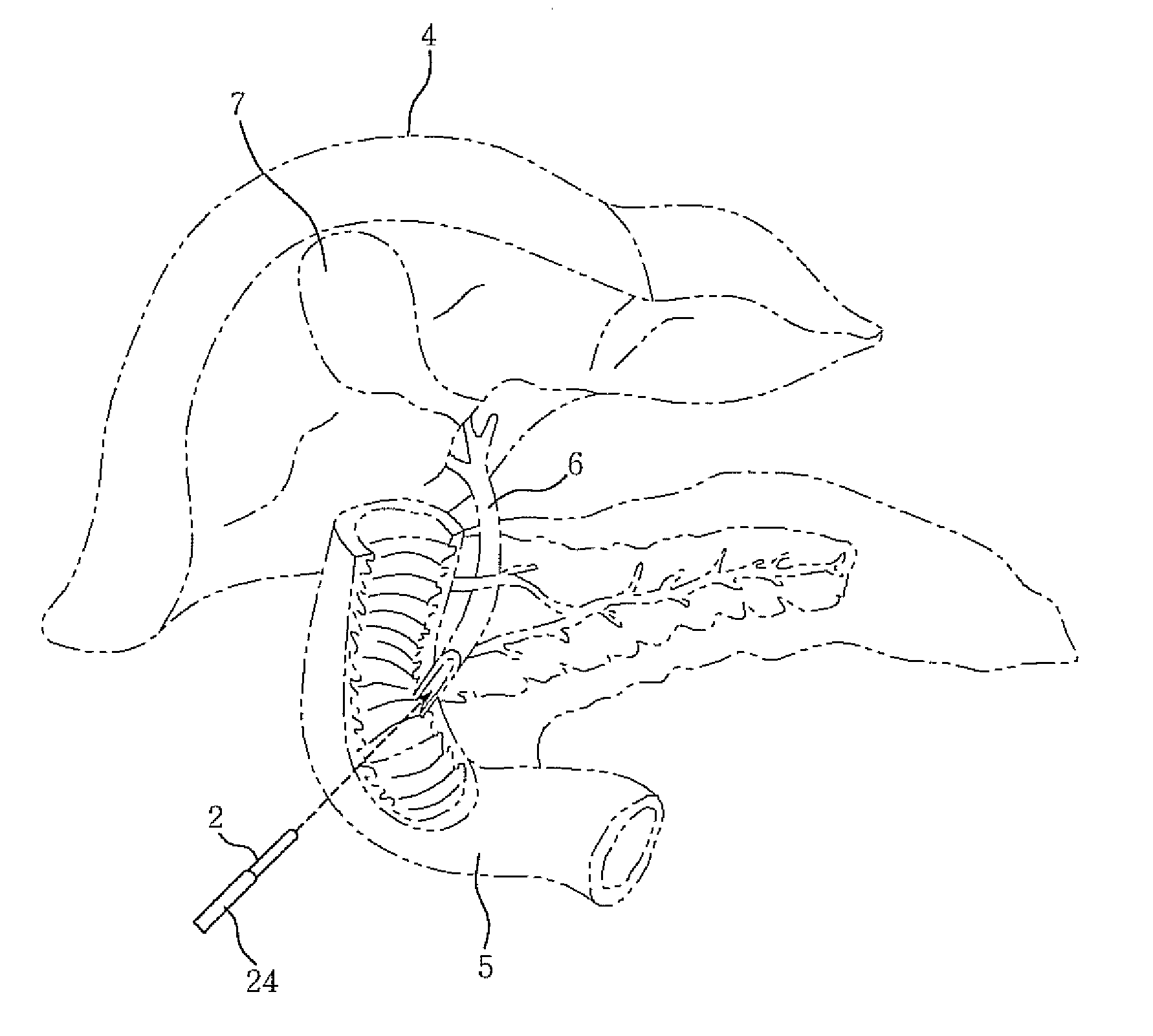 Plastic stent and stent operation apparatus for the same