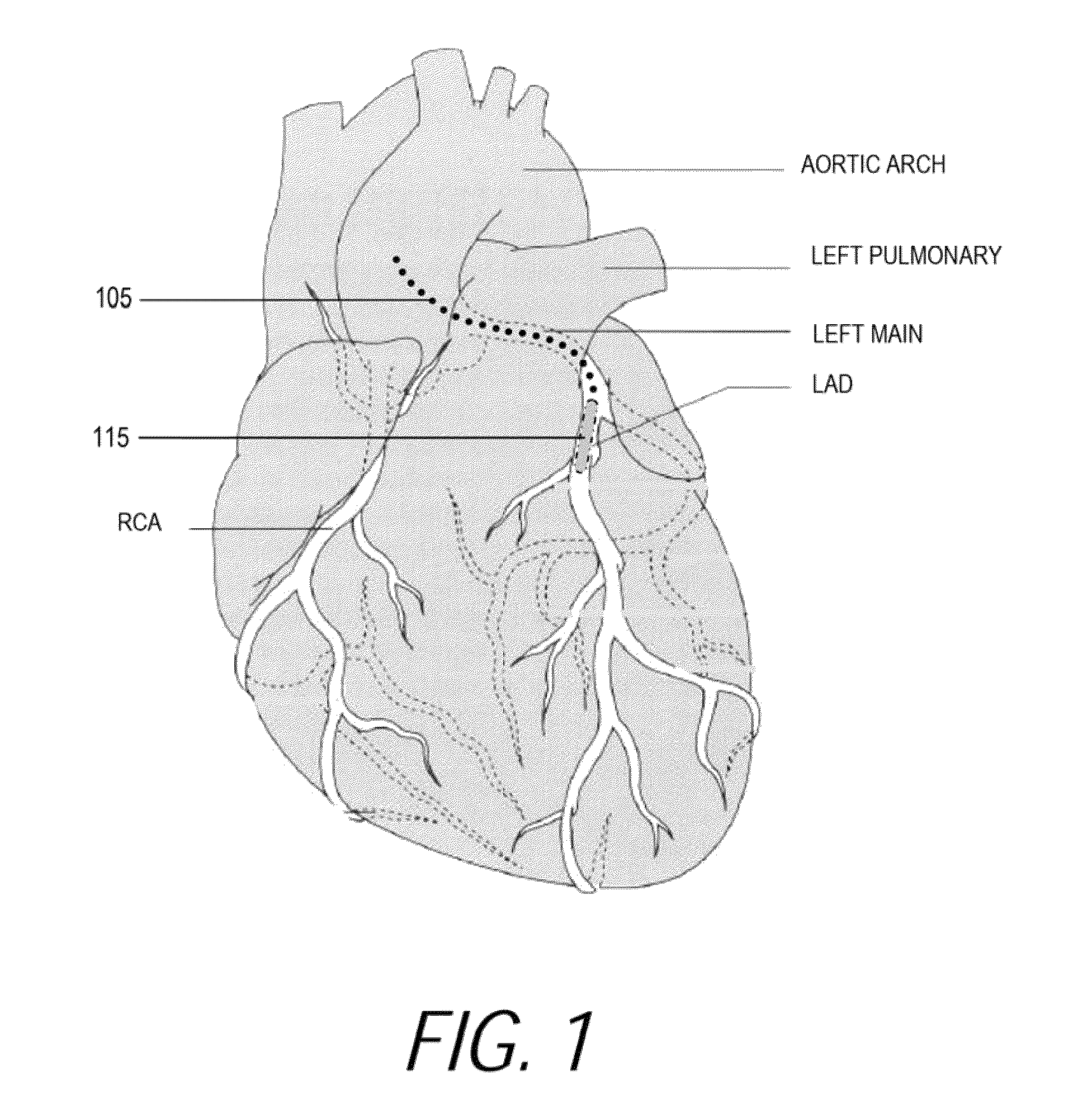 Medical probes for the treatment of blood vessels