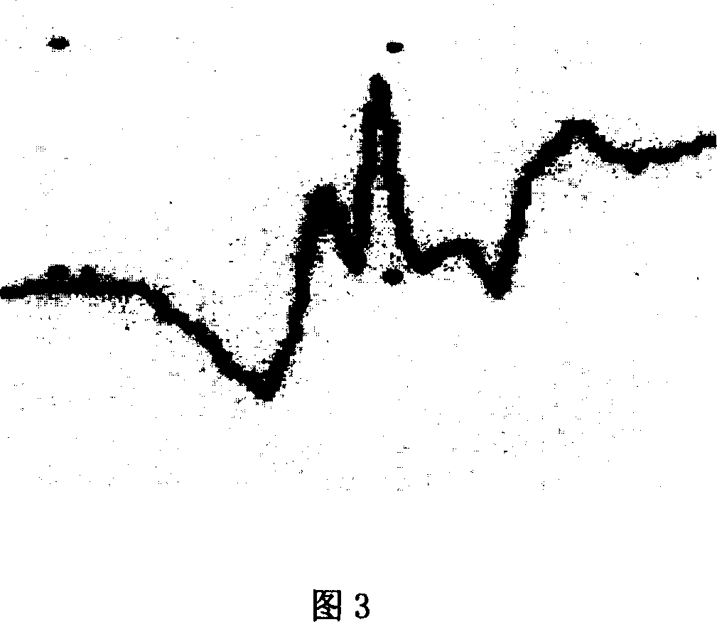 Bone marrow interstital stem cell preparation and its combined use with controlled release neurotrophic factor