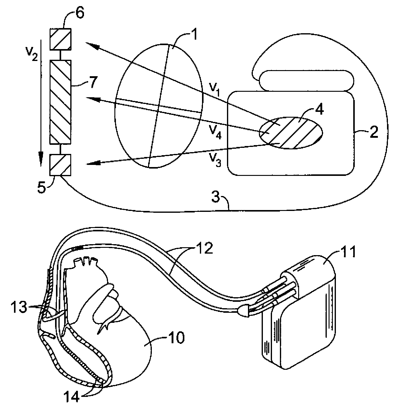 Method and devices for performing cardiac waveform appraisal