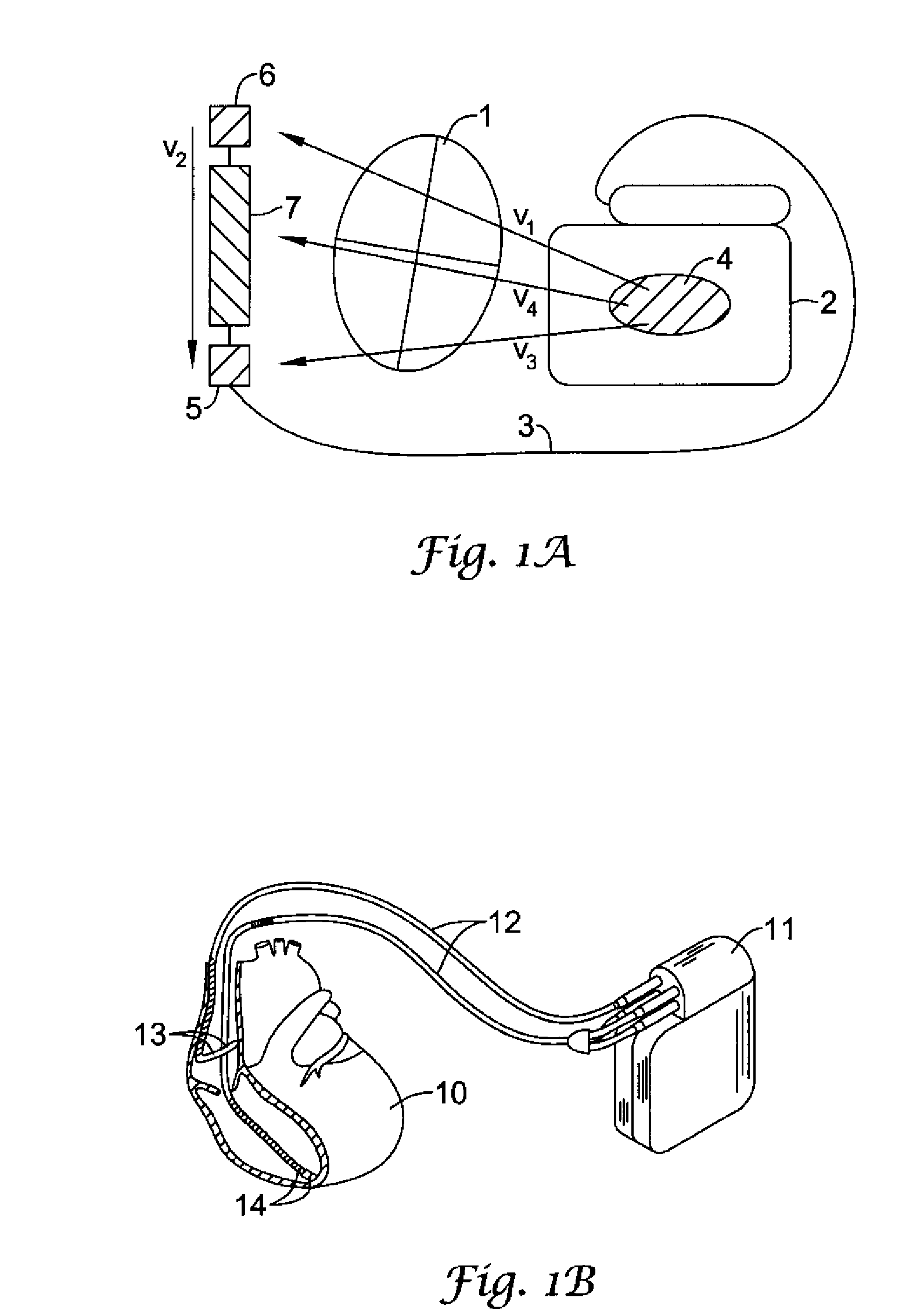 Method and devices for performing cardiac waveform appraisal