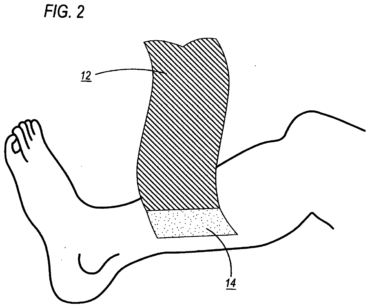 Antimicrobial compression wrap