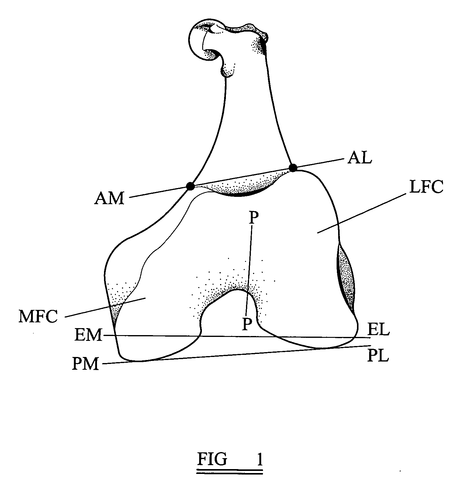 Knee prosthesis