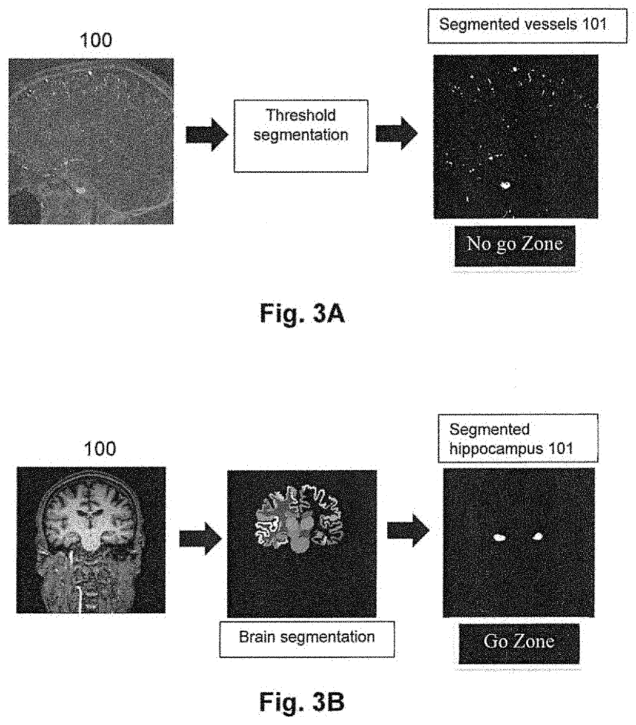 Computer implemented method, a system and computer programs for computing simultaneous rectilinear paths using medical images