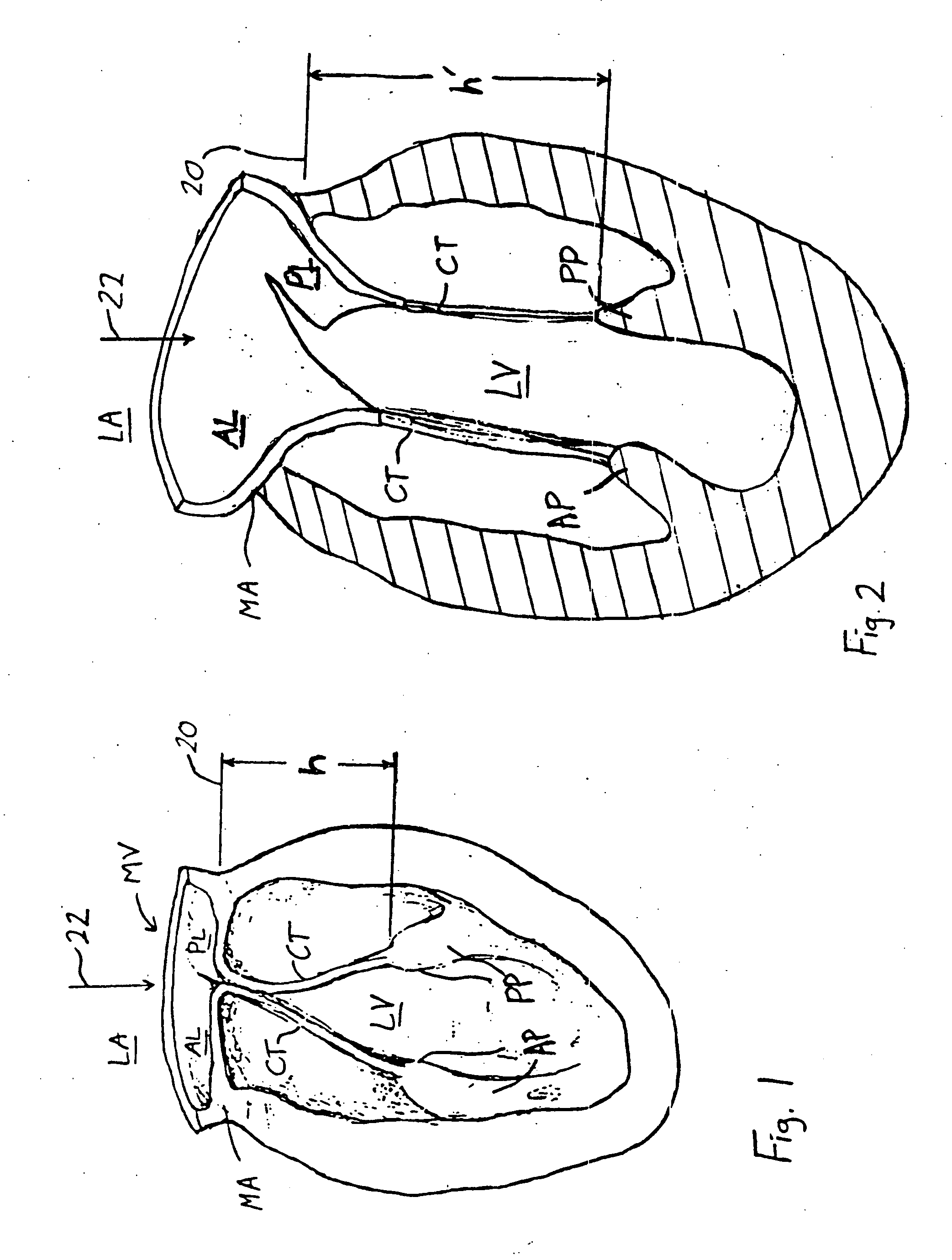 Annuloplasty rings for repair of abnormal mitral valves