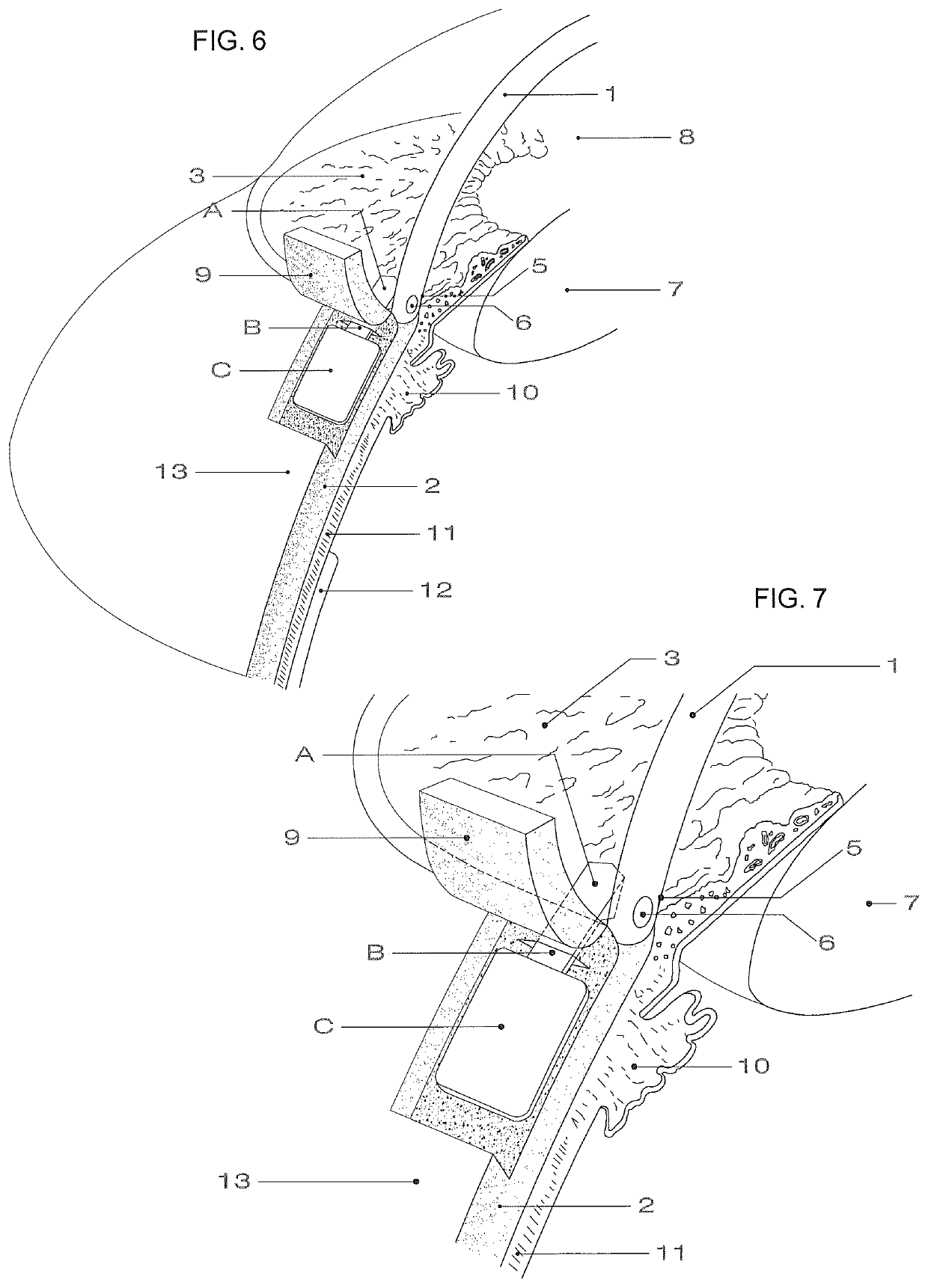 One piece flat device of for the drainage of aqueous humor from the eye