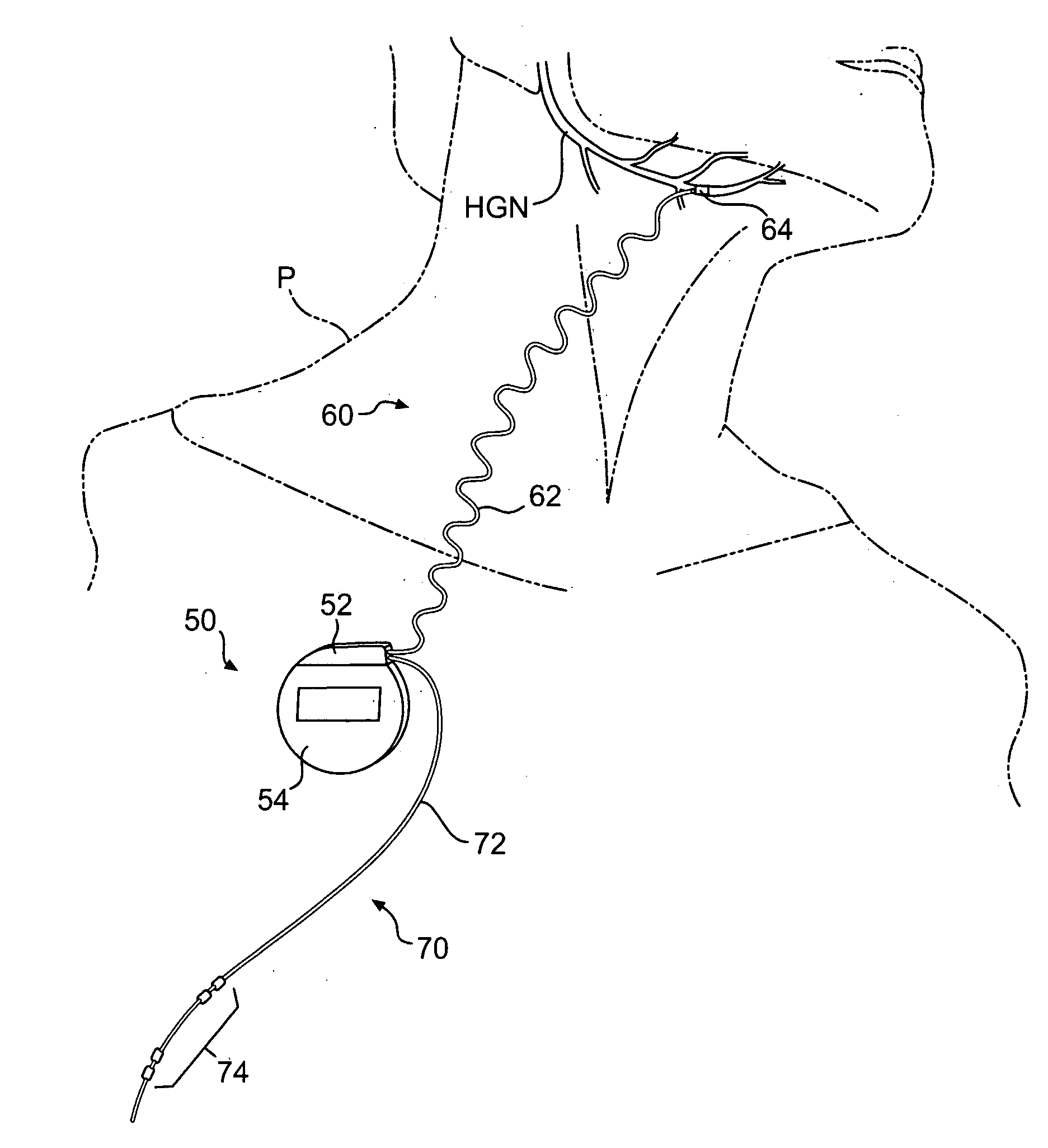 Obstructive sleep apnea treatment devices, systems and methods