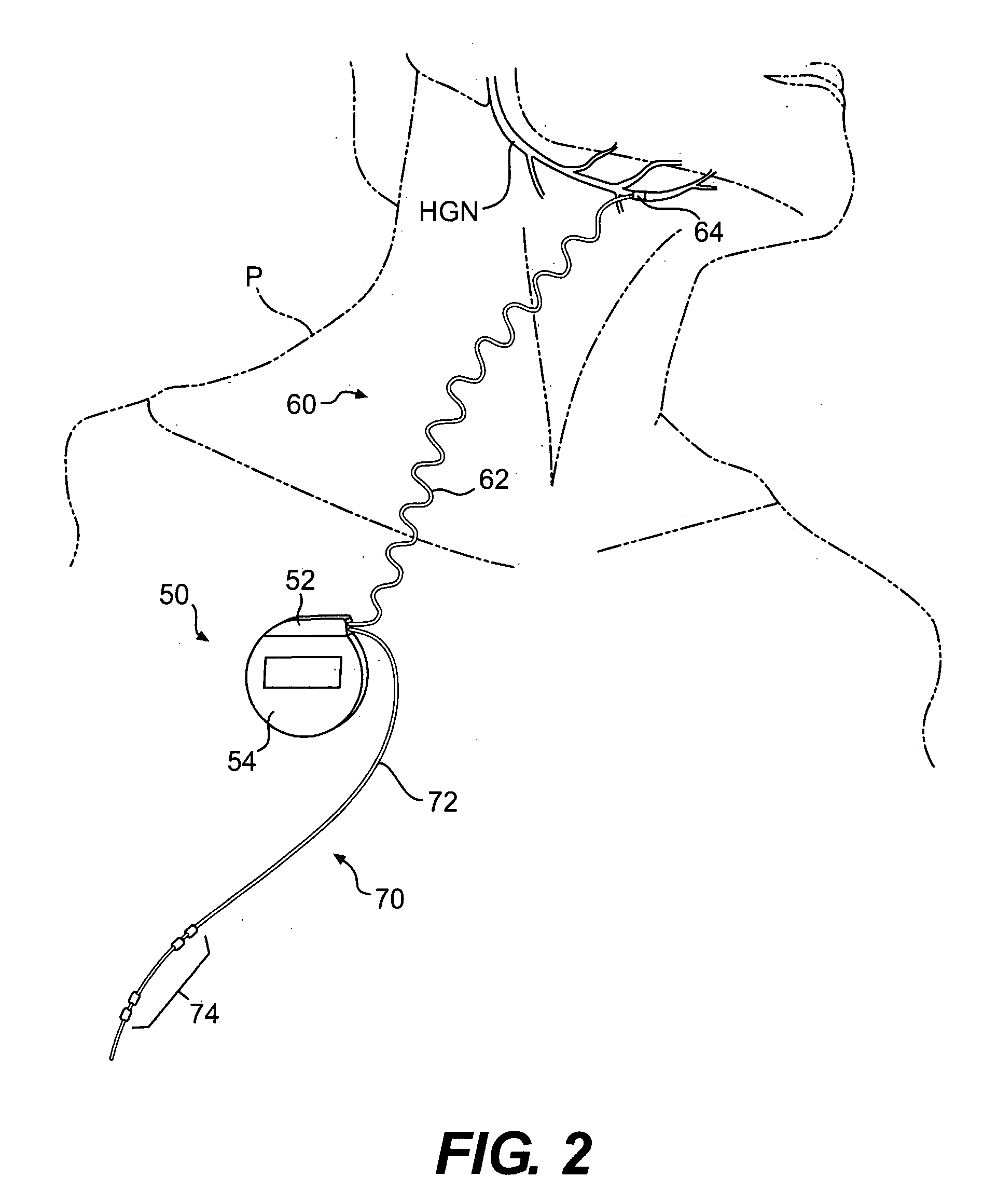 Obstructive sleep apnea treatment devices, systems and methods