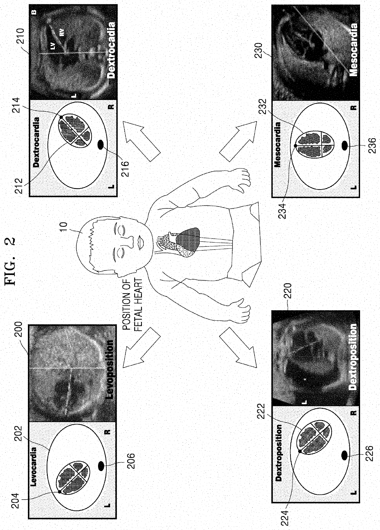 Ultrasound diagnosis apparatus for determining abnormality of fetal heart, and operating method thereof