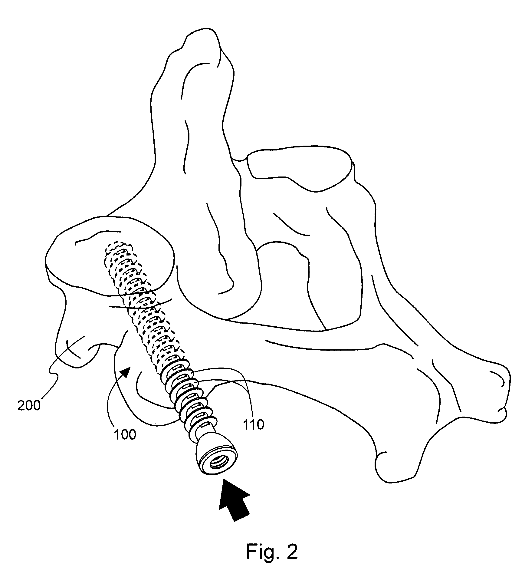 Method and device for delivering medicine to bone