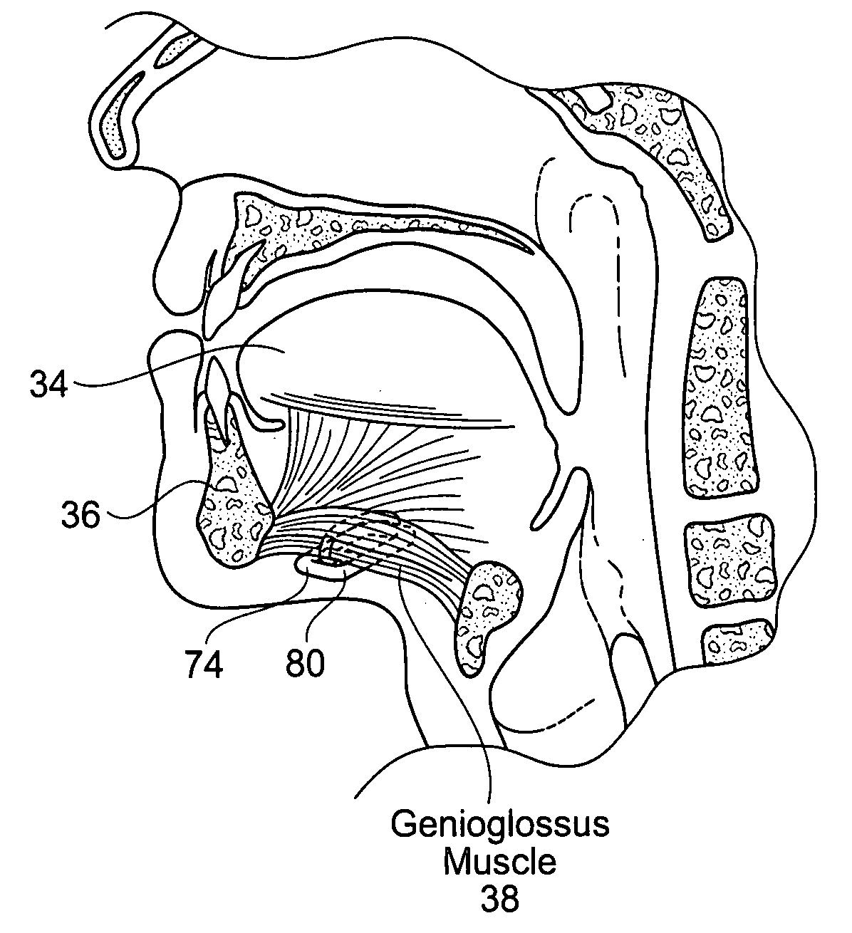 Implantable devices, systems, and methods for maintaining desired orientations in targeted tissue regions