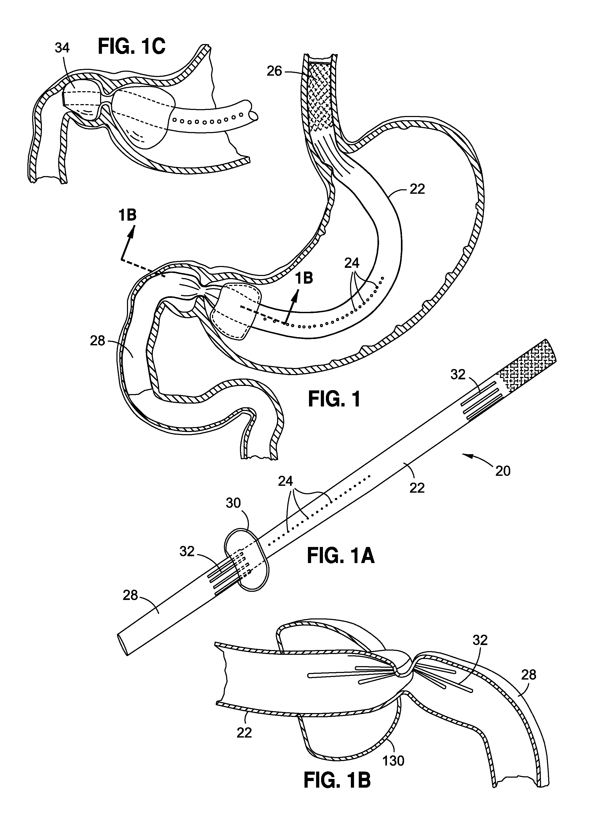 Stomach-spanning gastric implants