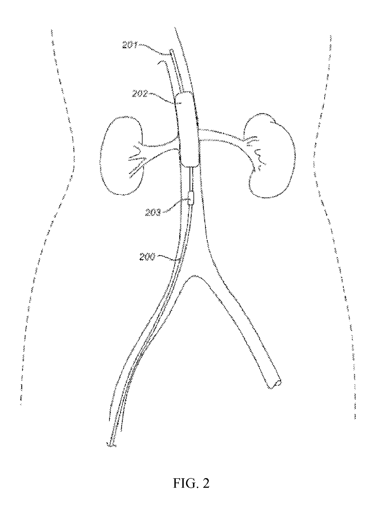 Devices and methods for treating acute kidney injury