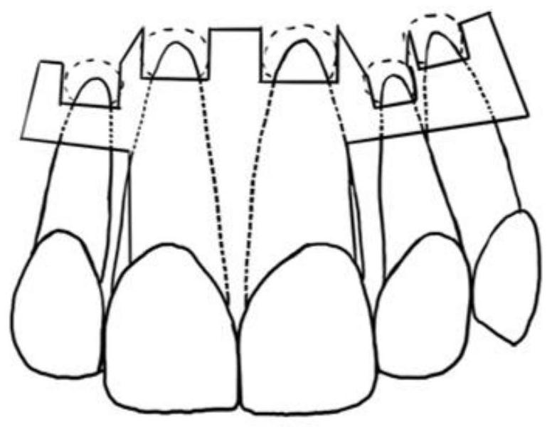 A kind of root tip operation guide plate and manufacturing method thereof