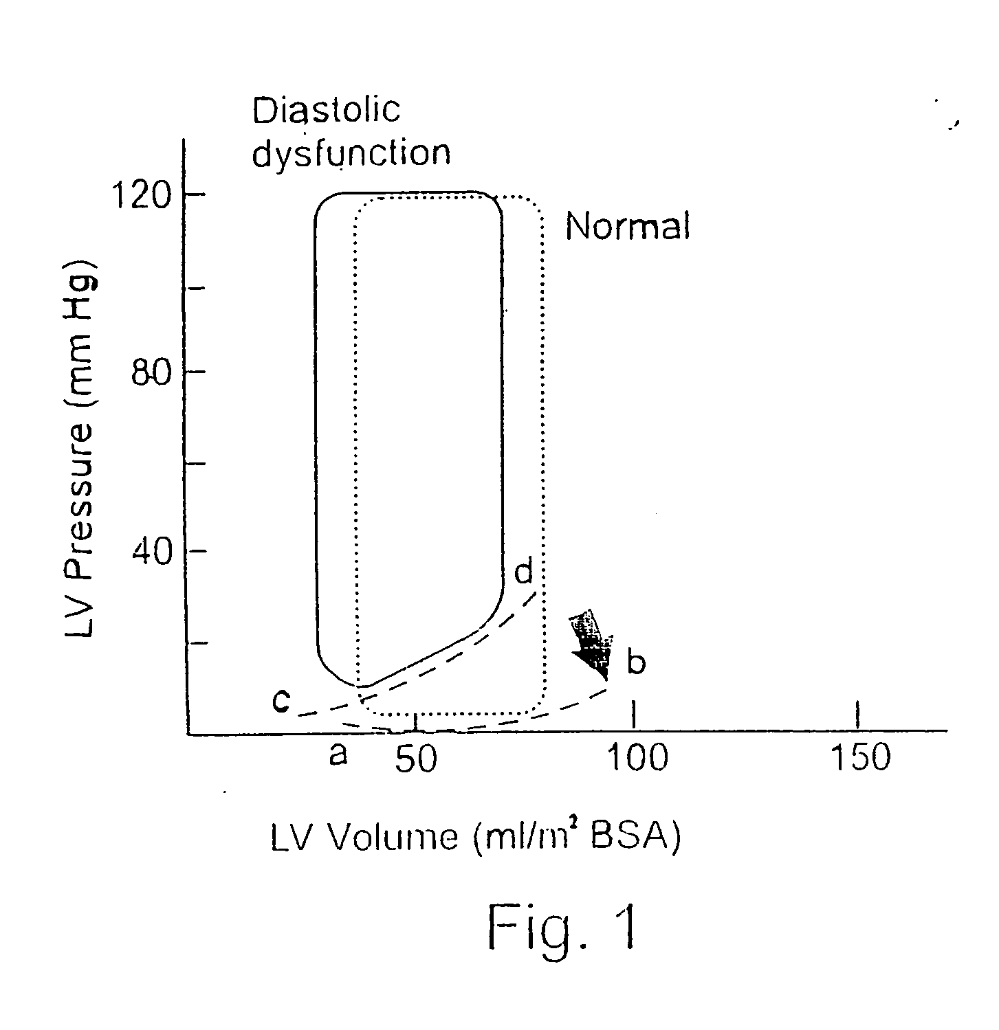 In vivo device for improving diastolic ventricular function