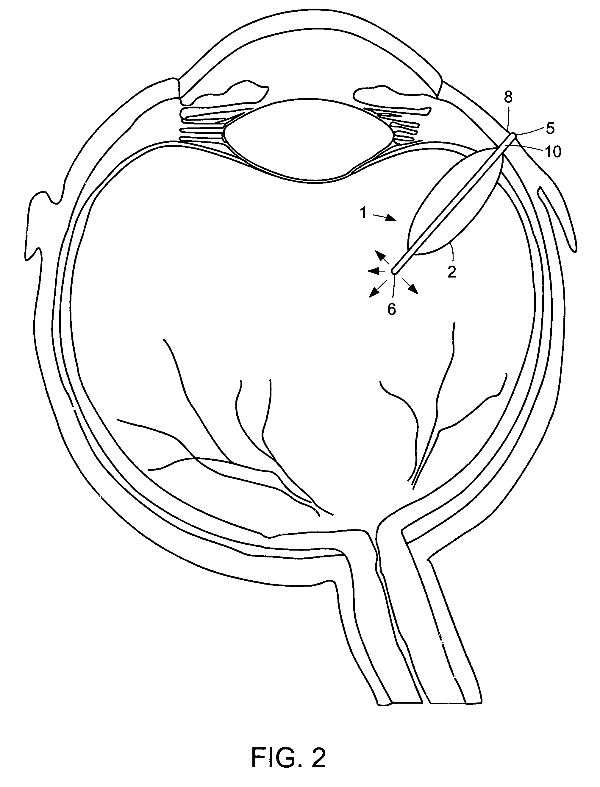 Reservoir device for intraocular drug delivery