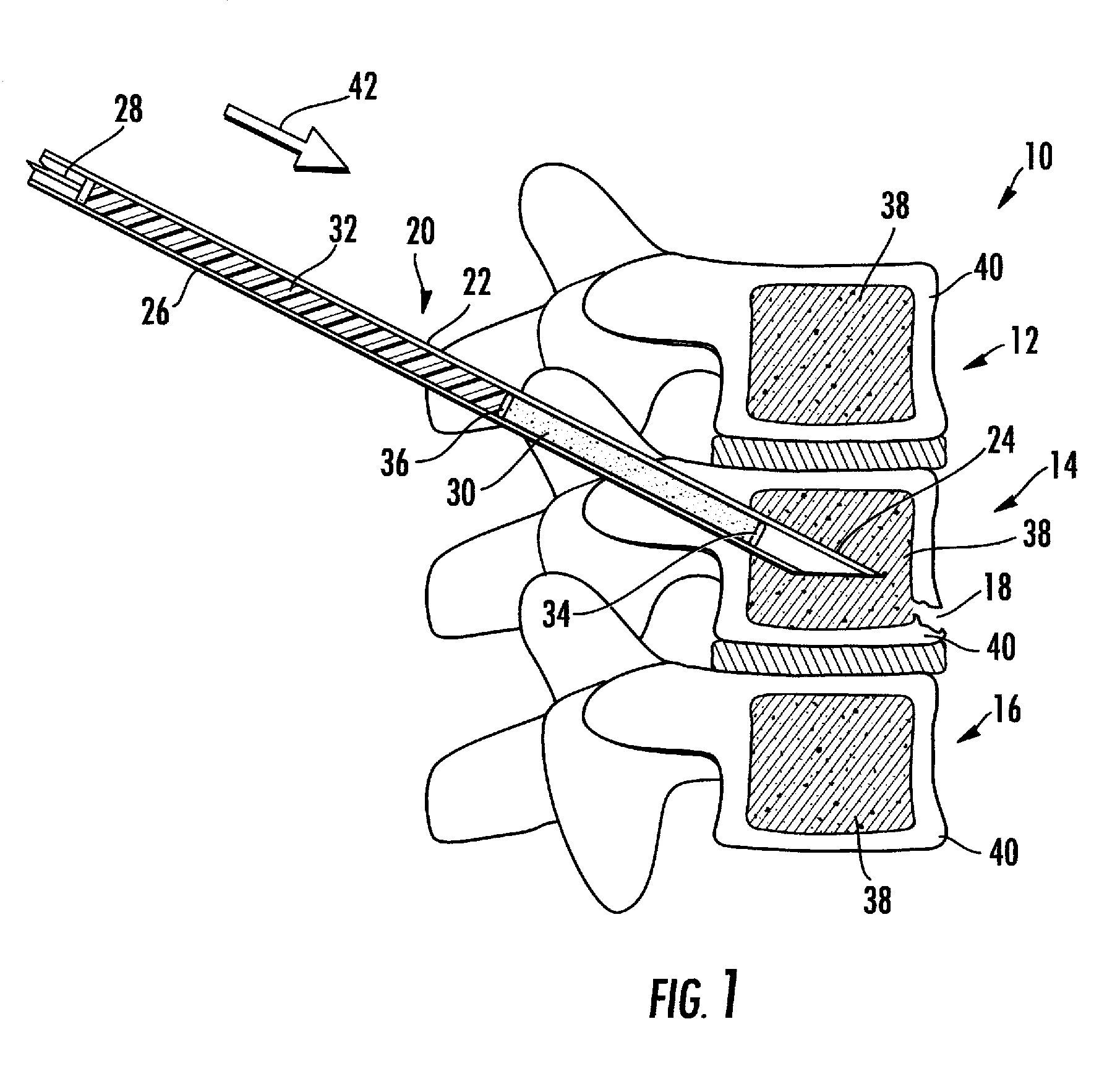 Method and composition for use in reinforcing bone