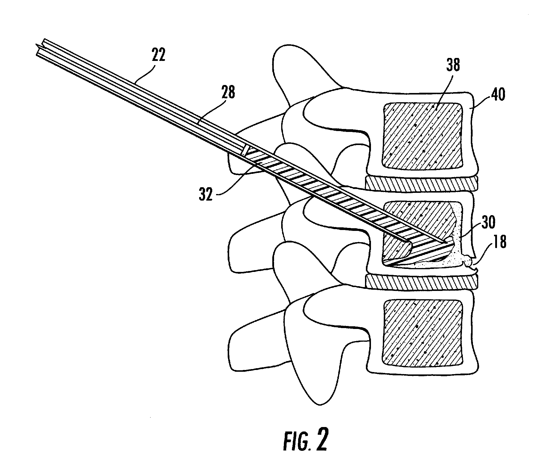 Method and composition for use in reinforcing bone