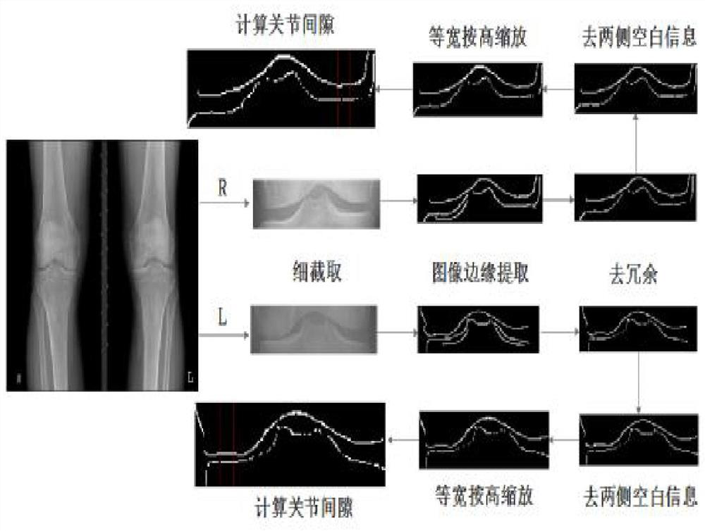 An automatic grading method for osteoarthritis