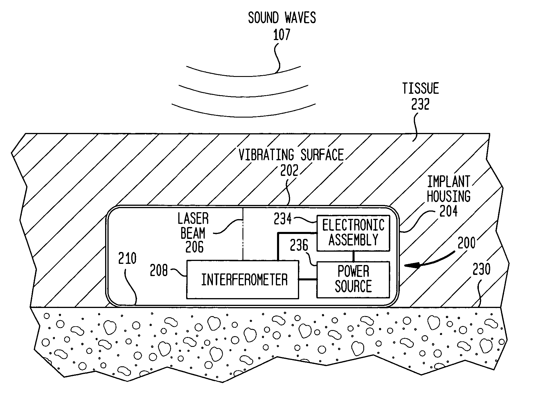 Implantable interferometer microphone