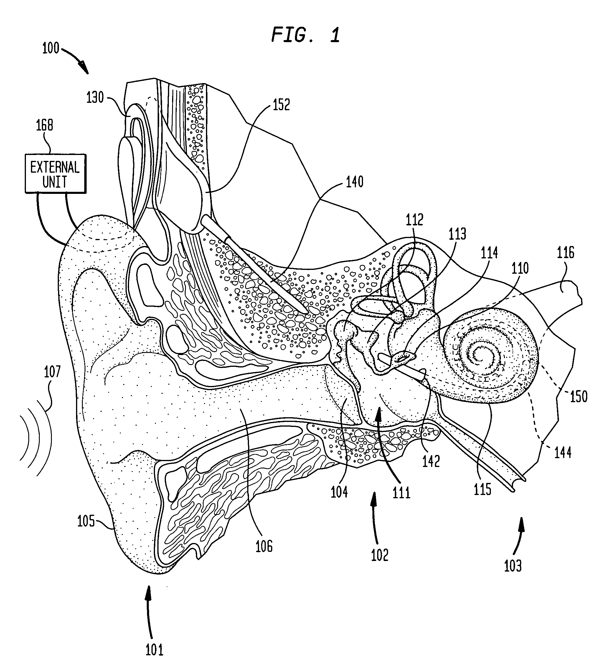 Implantable interferometer microphone