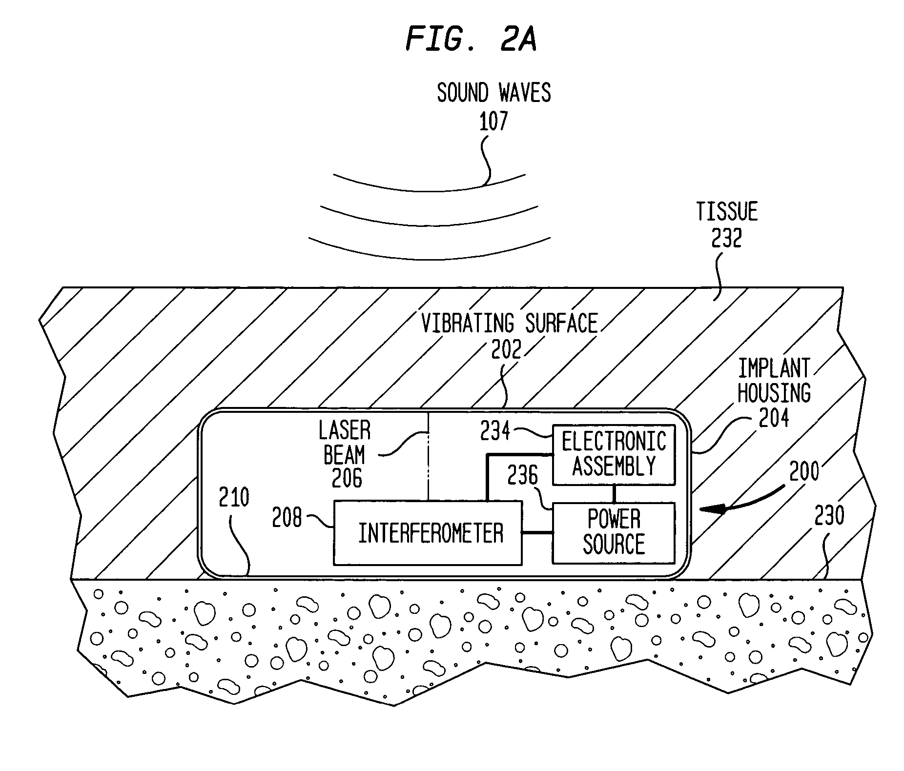 Implantable interferometer microphone