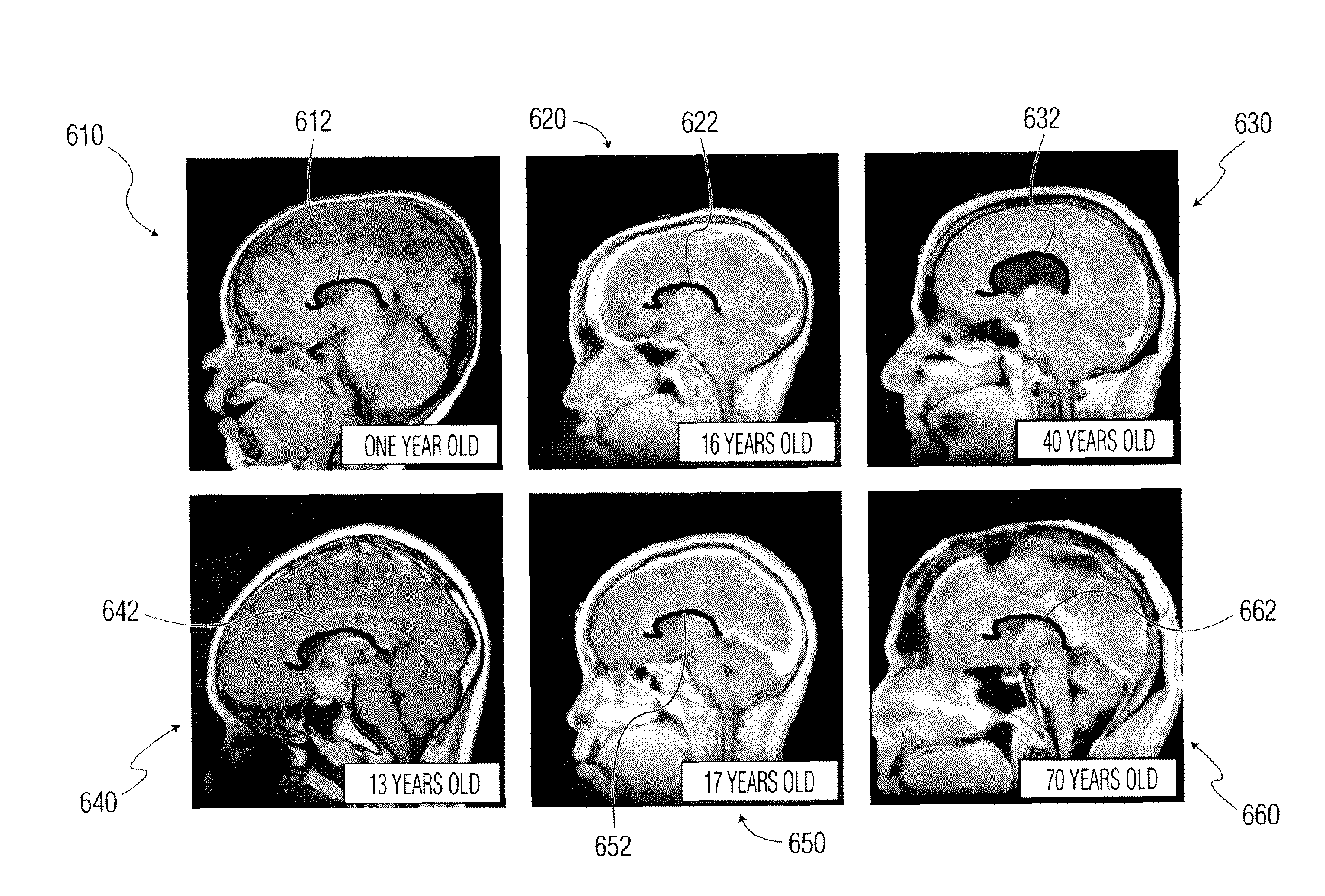 System and method for corpus callosum segmentation in magnetic resonance images