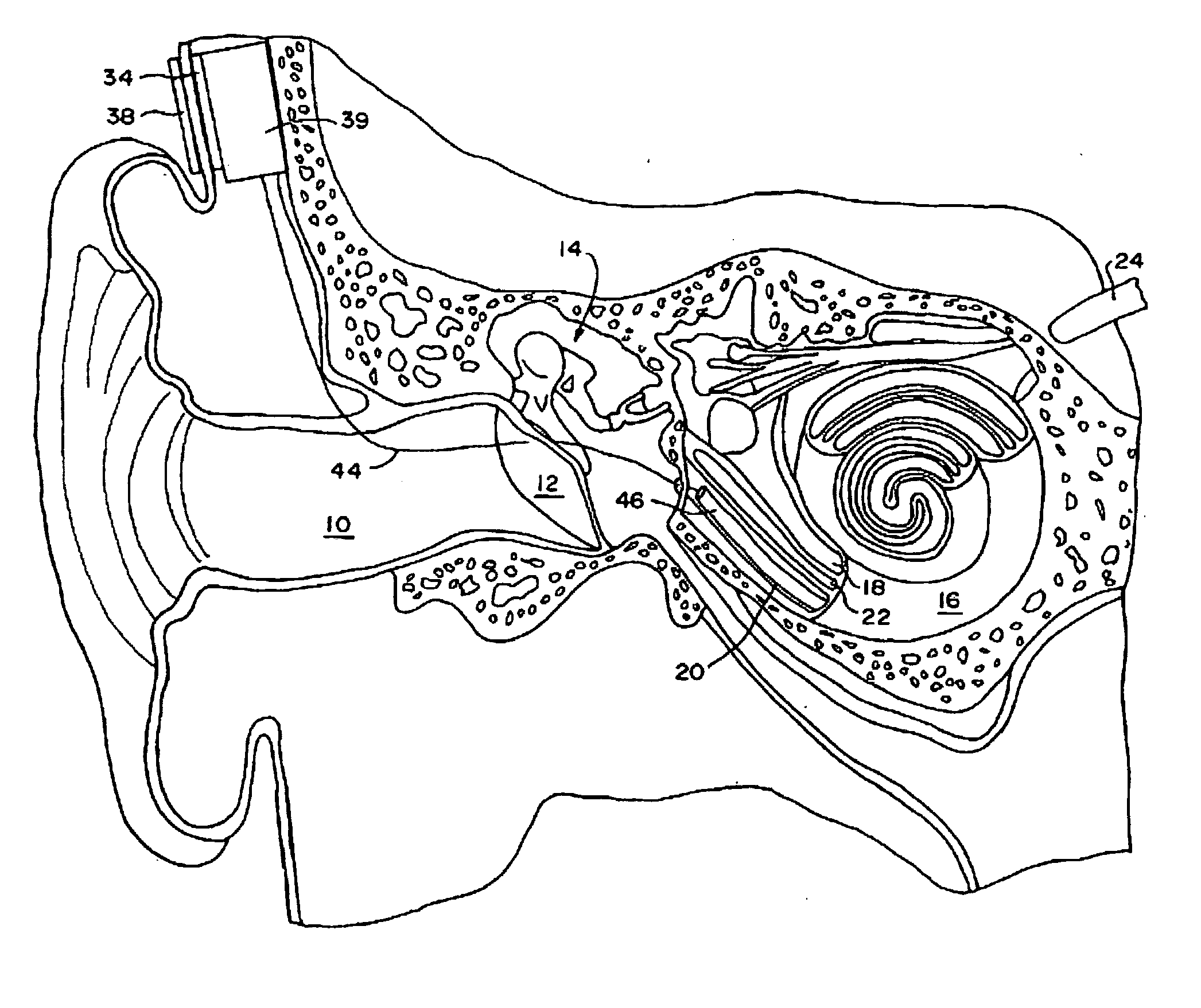 Middle ear multi-channel electrode