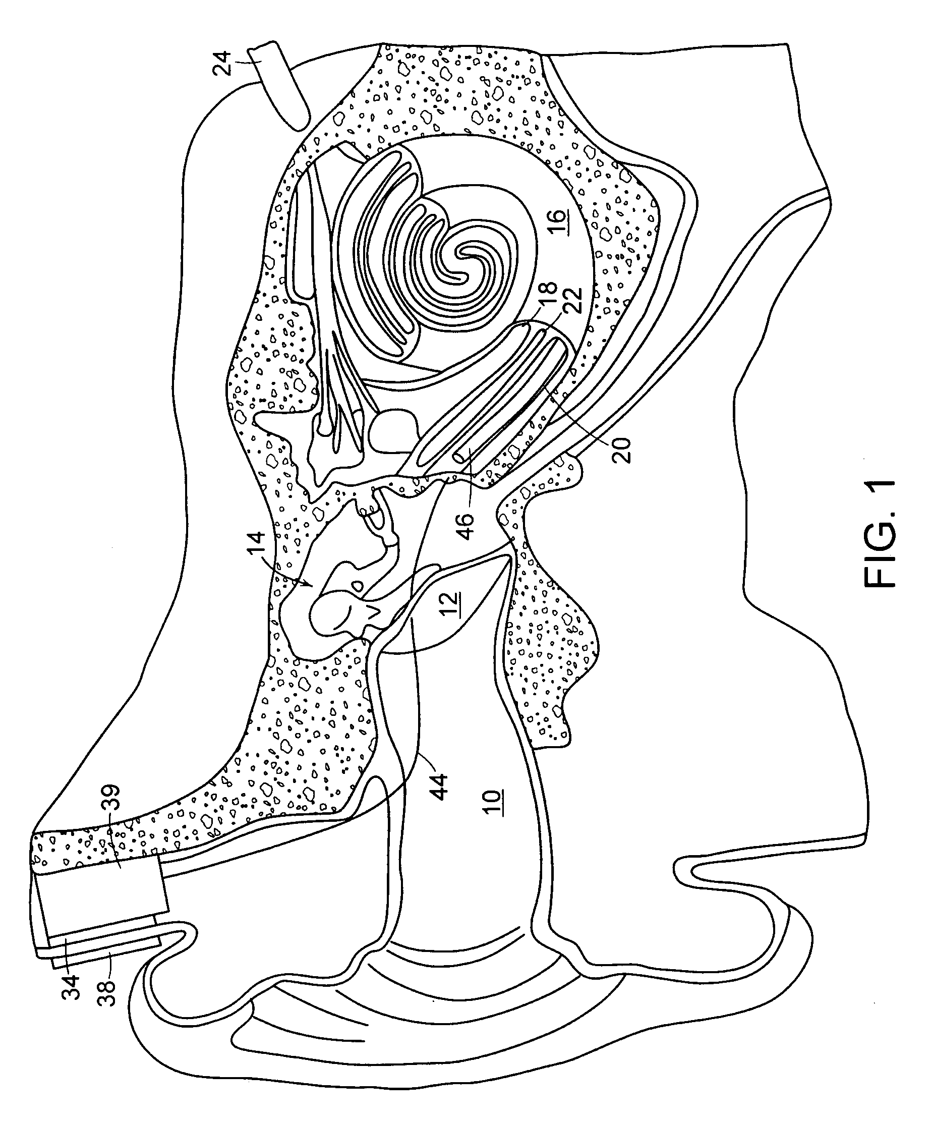 Middle ear multi-channel electrode