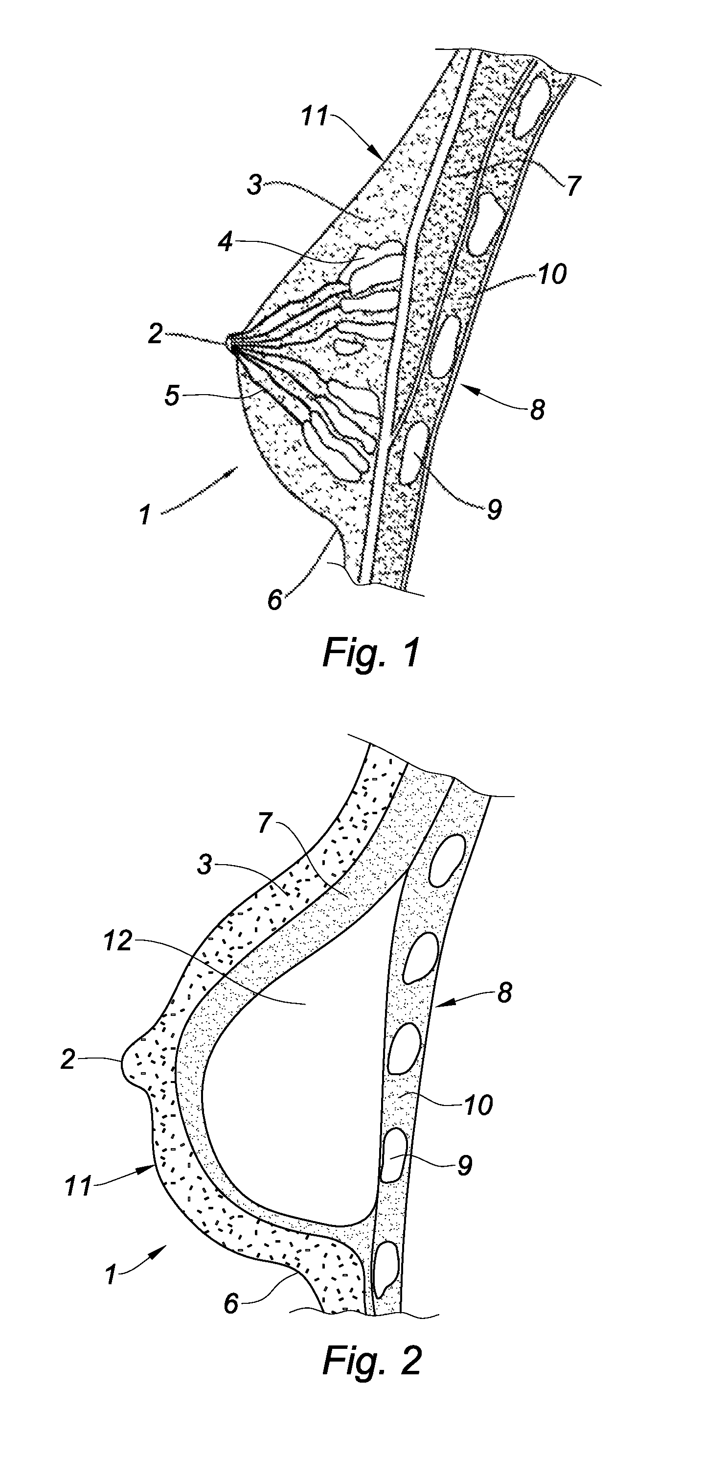 Prosthesis for supporting a breast structure