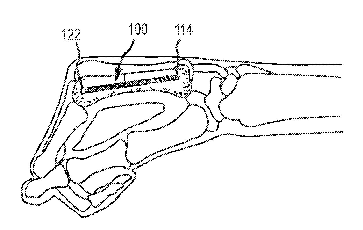 Metacarpal bone stabilization device