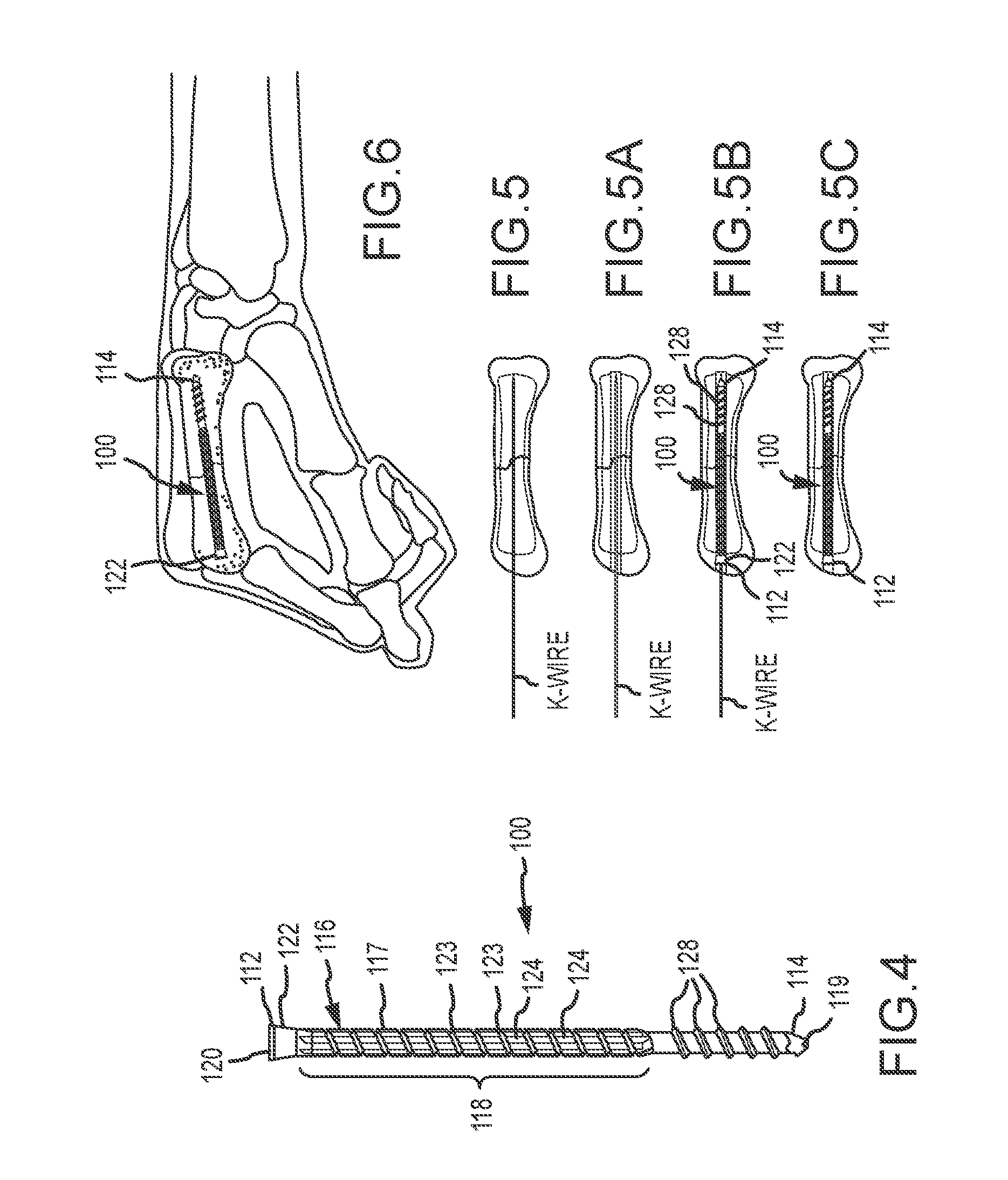 Metacarpal bone stabilization device