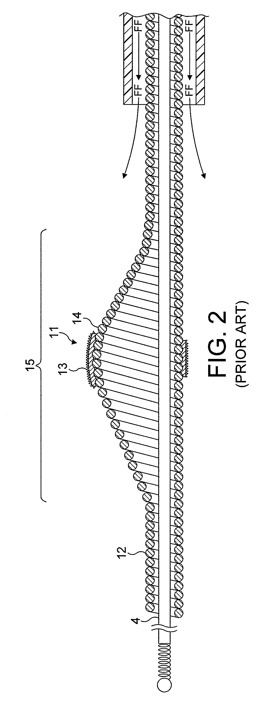 Rotational atherectomy system with enhanced distal protection capability and method of use