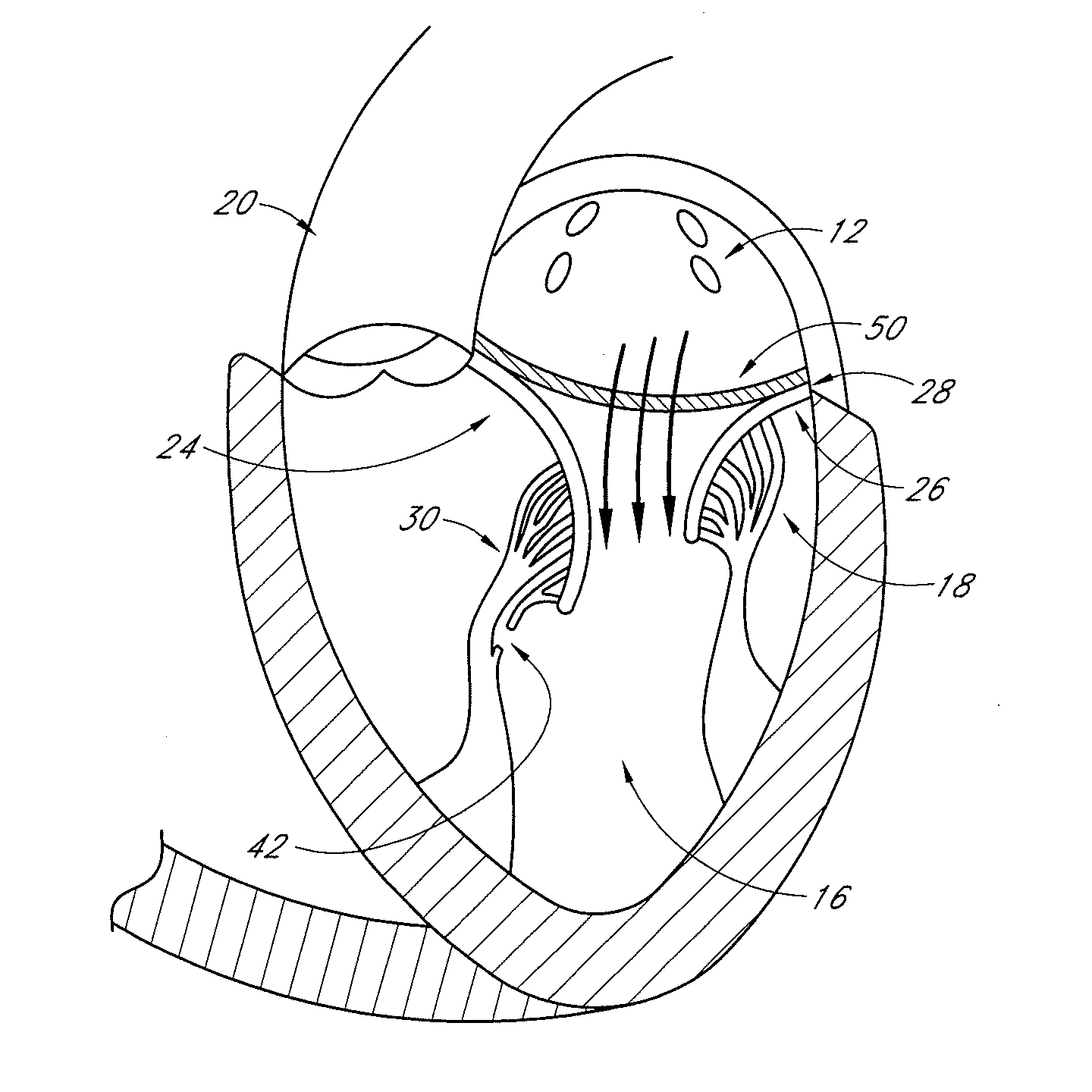 Transvalvular intraannular band for aortic valve repair