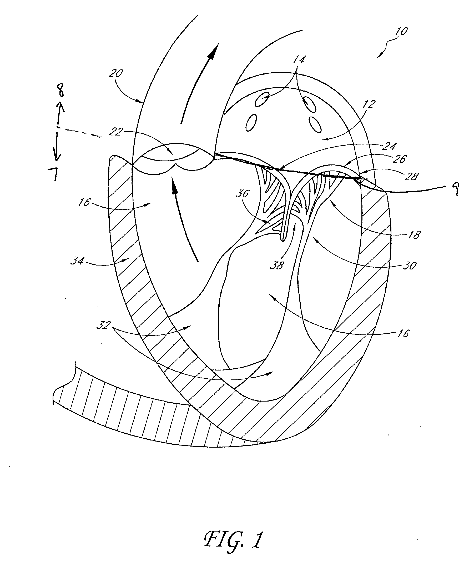 Transvalvular intraannular band for aortic valve repair